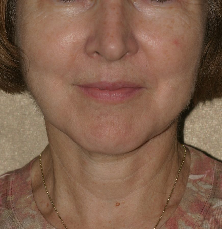 Neck Lift - Before & After - Dr. Placik