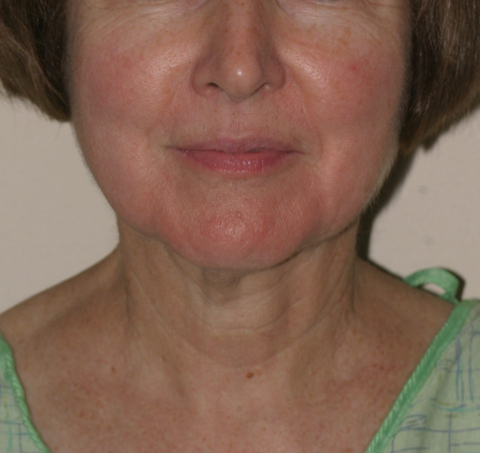 Neck Lift - Before & After - Dr. Placik