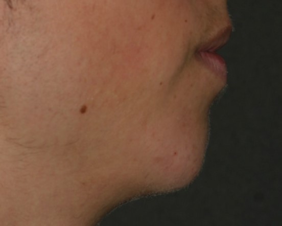 Injectable Filler - Before & After - Dr. Placik