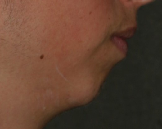 Injectable Filler - Before & After - Dr. Placik