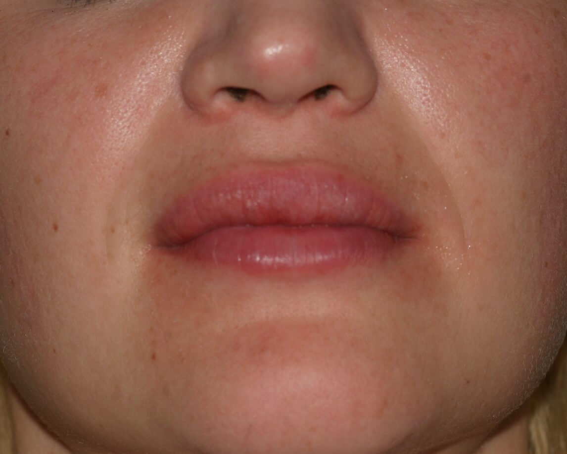 Lip Enhancement - Before & After - Dr. Placik