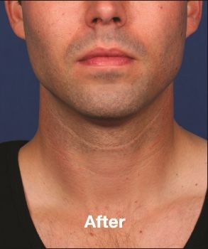 Injectables for Men - Before & After - Dr. Placik