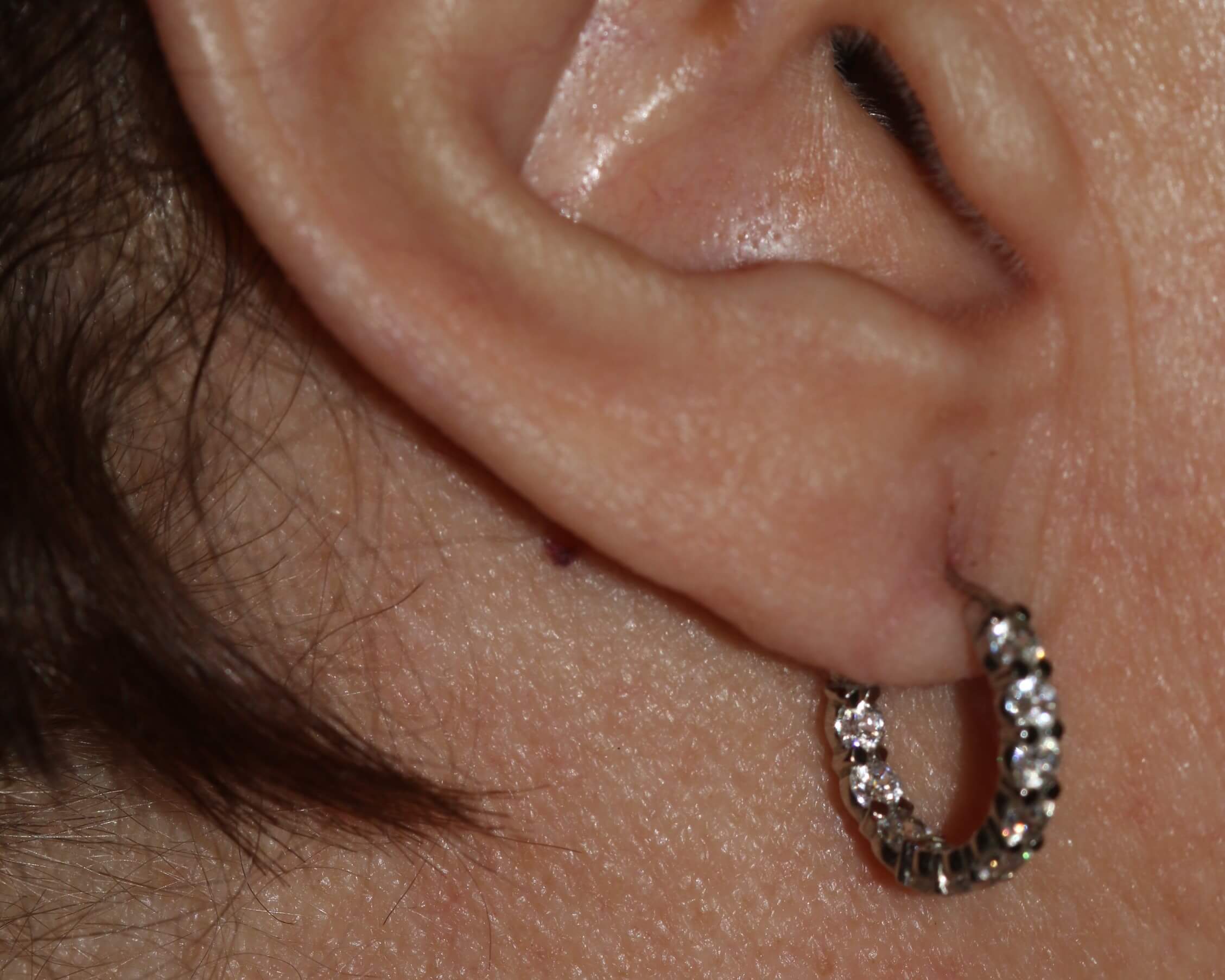 Earlobe Repair - Before & After - Dr. Placik