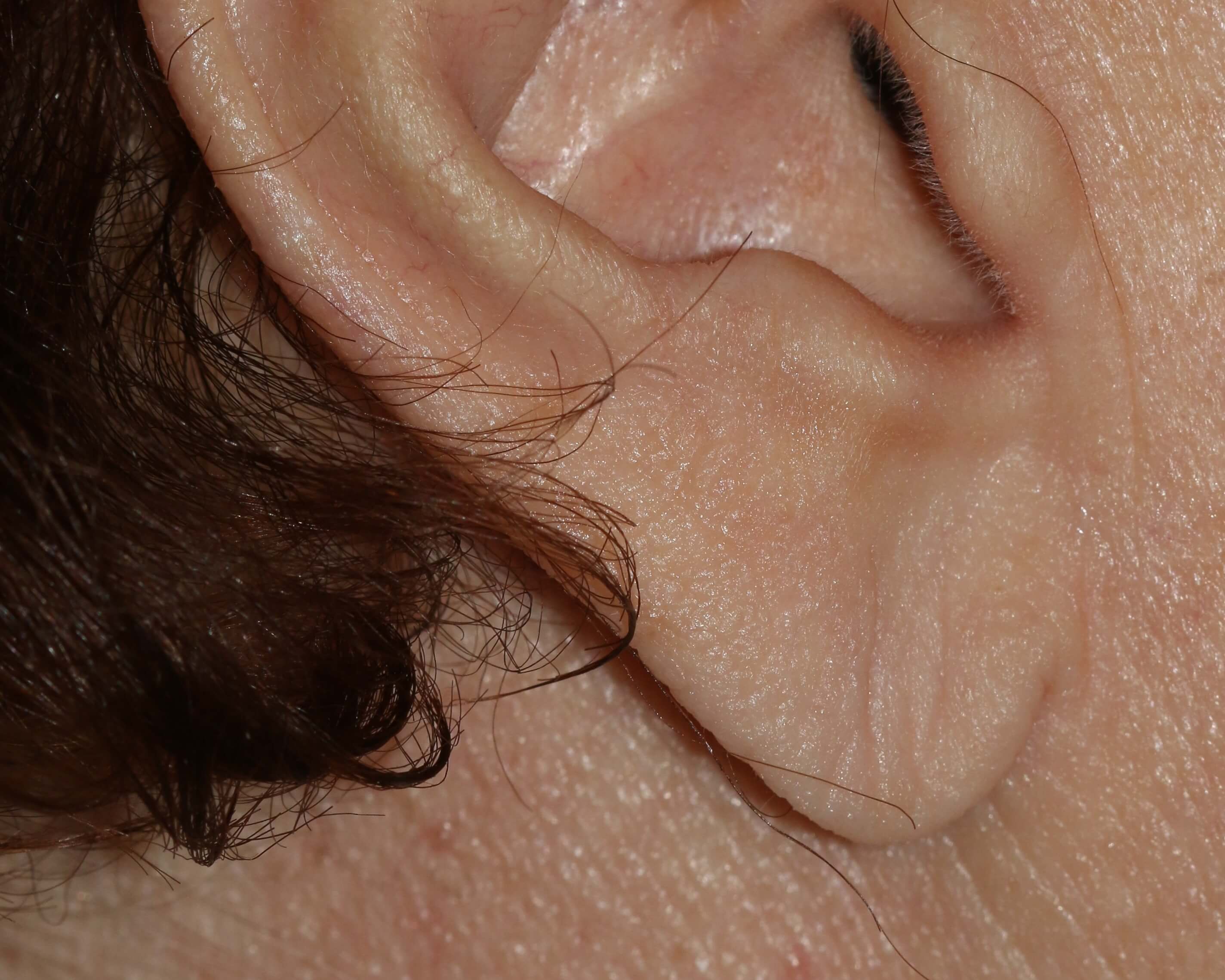 Earlobe Repair - Before & After - Dr. Placik