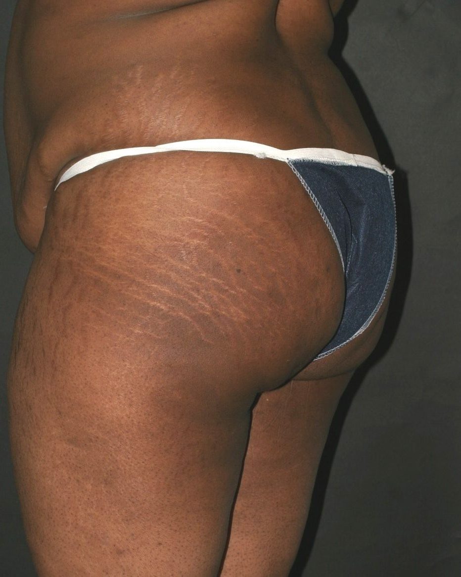 Butt Augmentation - Before & After - Dr. Placik