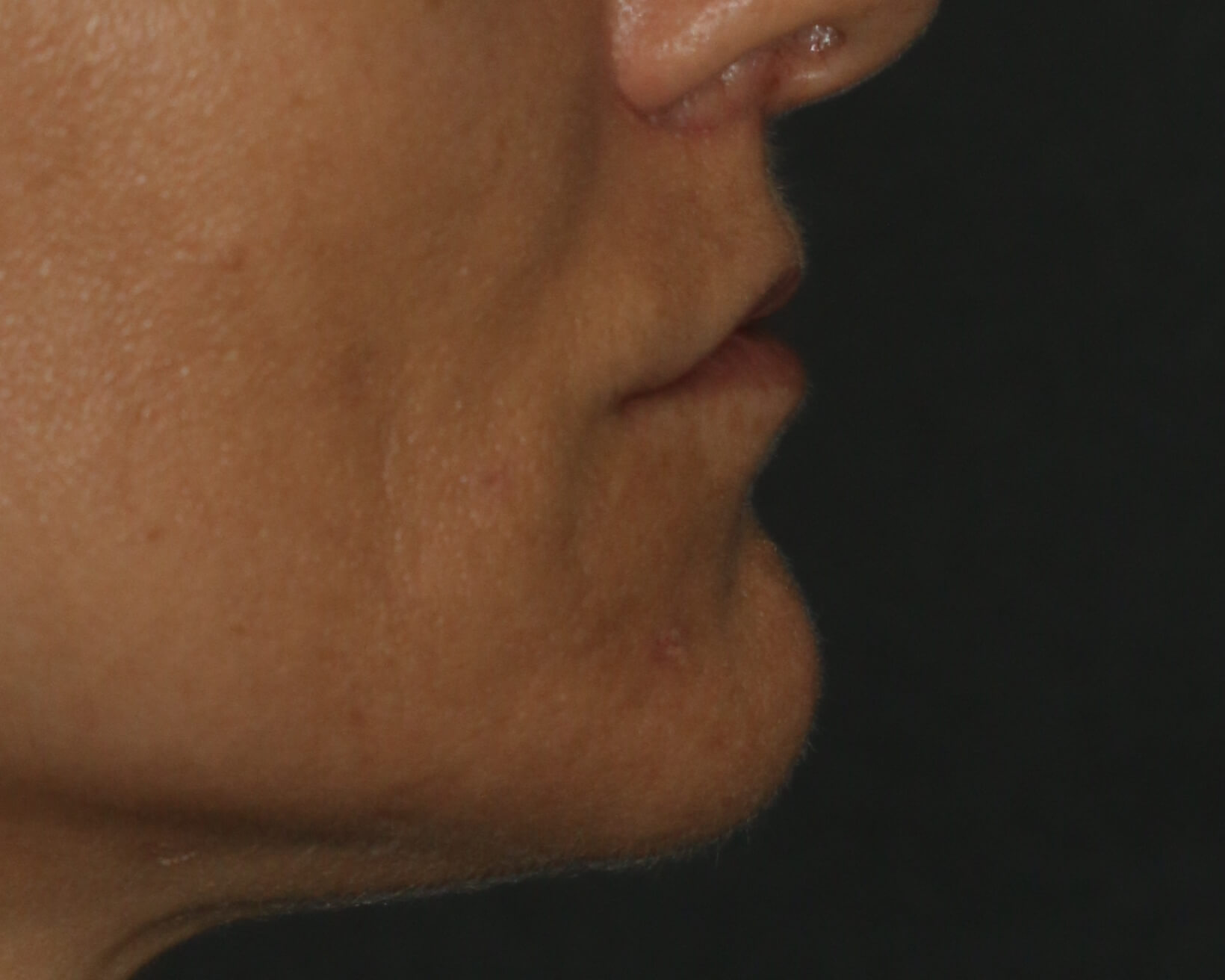 Lip Lift - Before & After - Dr. Placik