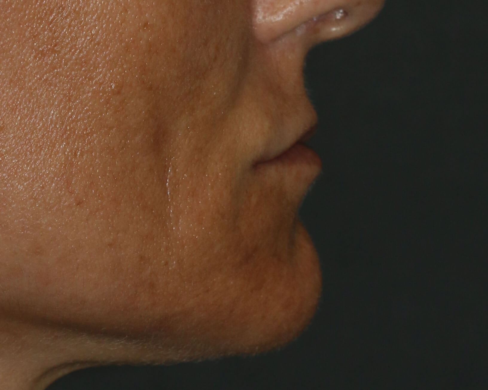 Lip Lift - Before & After - Dr. Placik