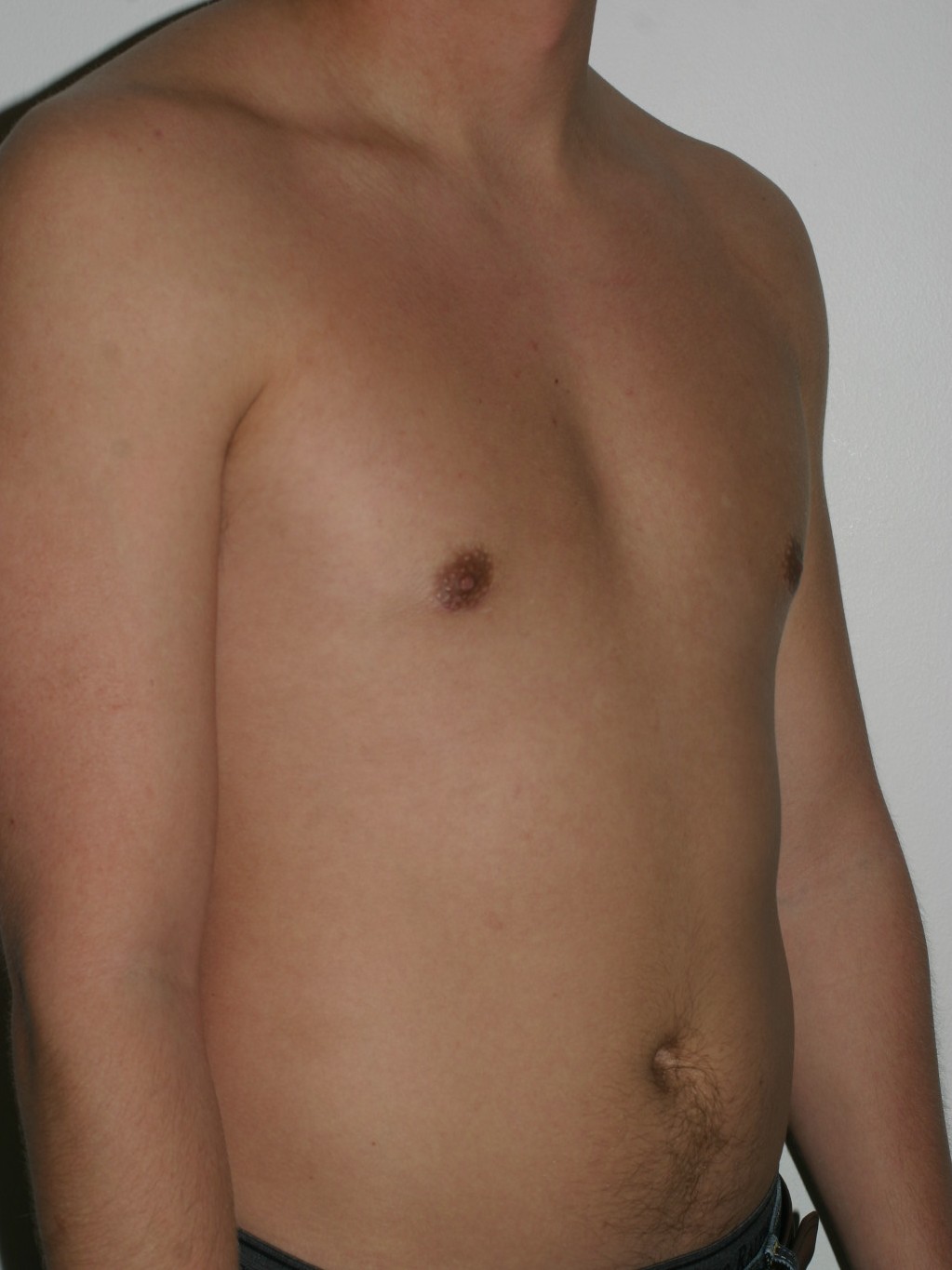 Male Breast Reduction - Before & After - Dr. Placik