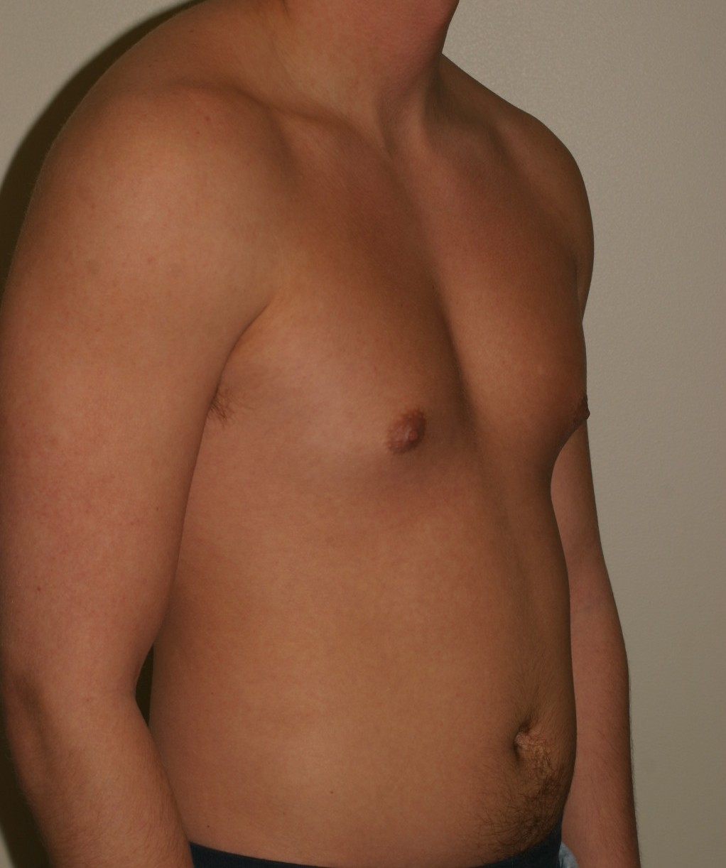 Male Breast Reduction - Before & After - Dr. Placik