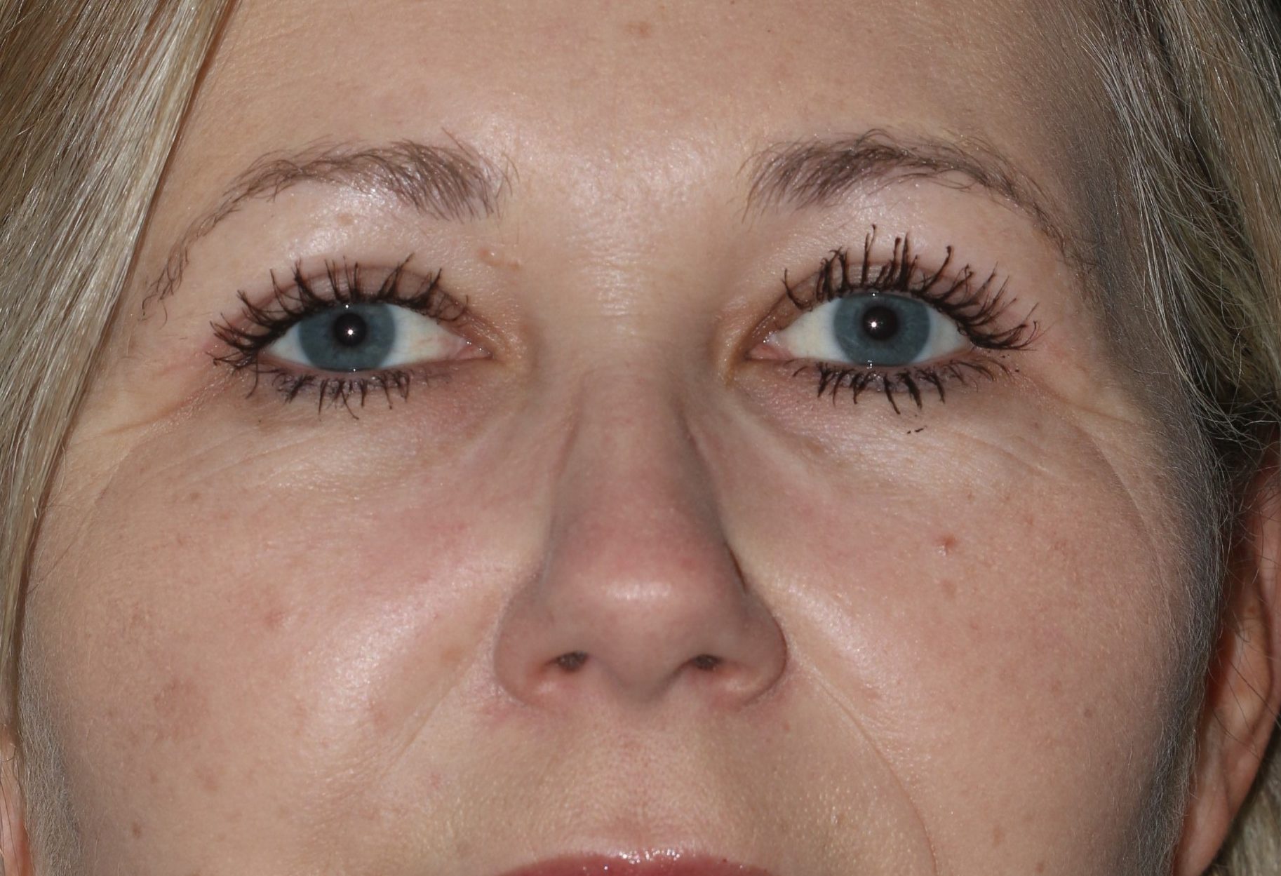 Eyelid Surgery - Before & After - Dr. Placik