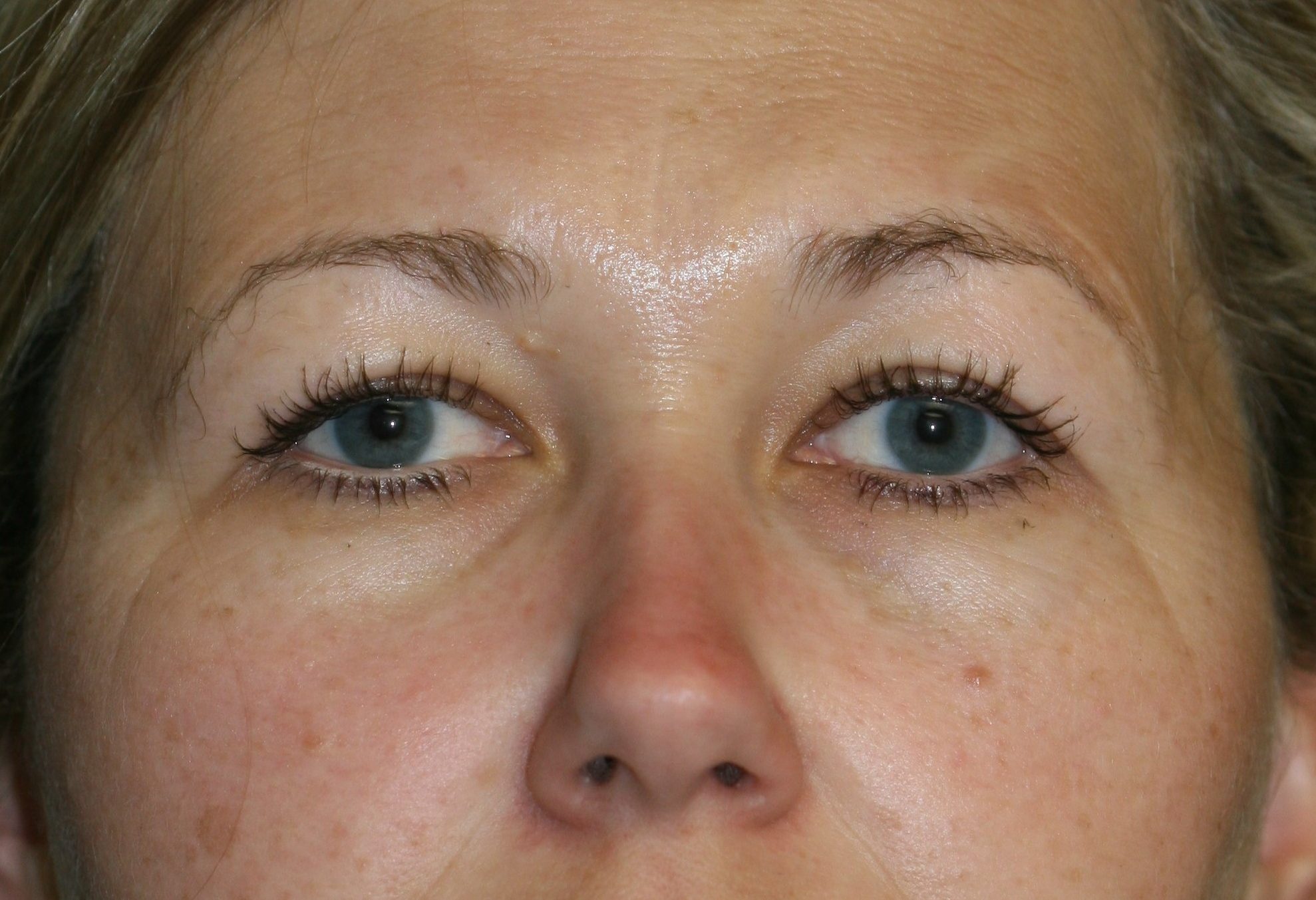 Eyelid Surgery - Before & After - Dr. Placik