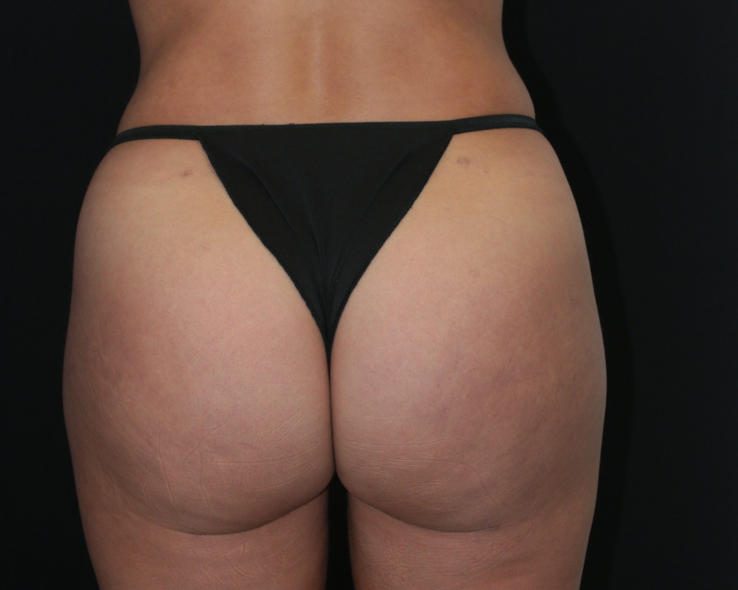 Butt Augmentation - Before & After - Dr. Placik