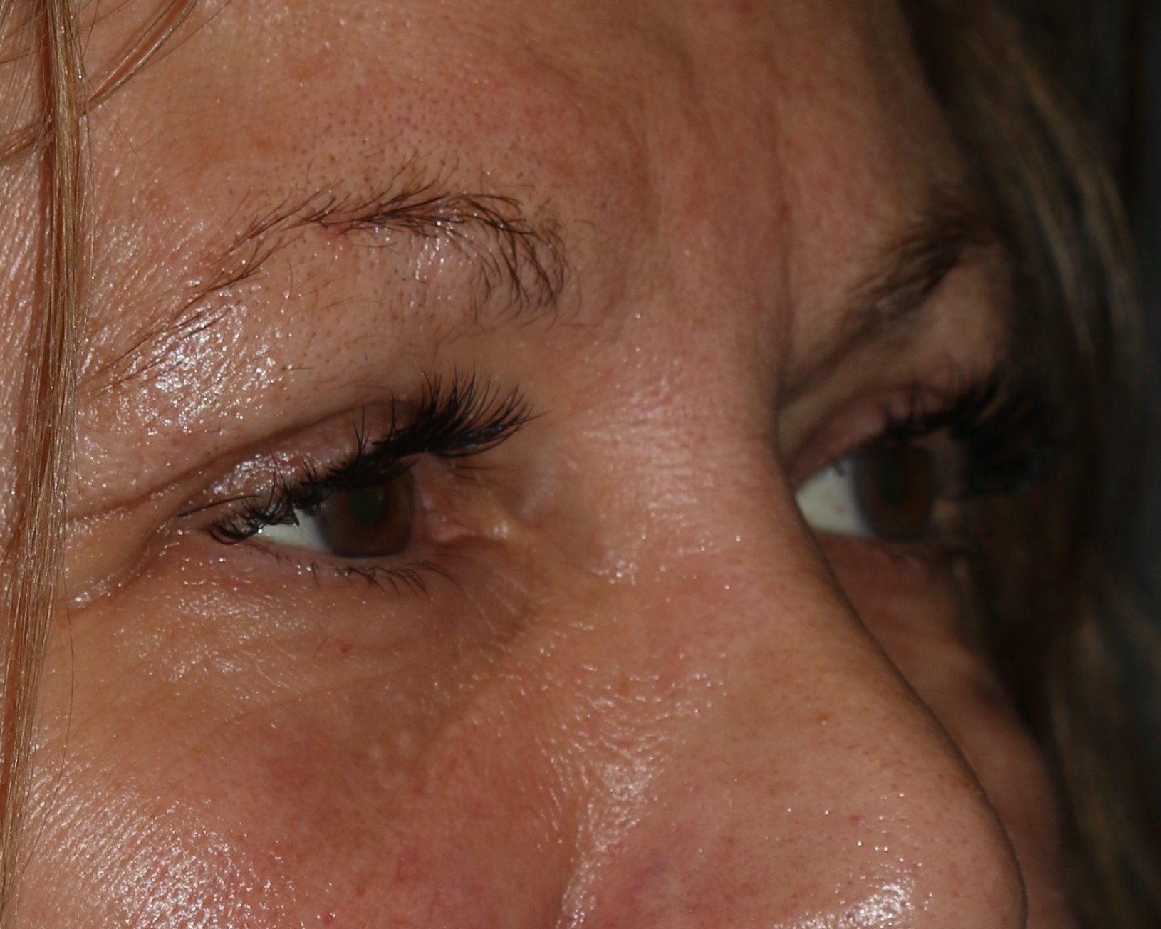 Eyelid Surgery - Before & After - Dr. Placik