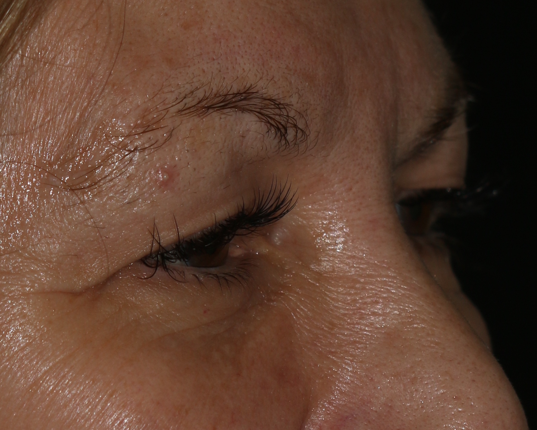 Eyelid Surgery - Before & After - Dr. Placik