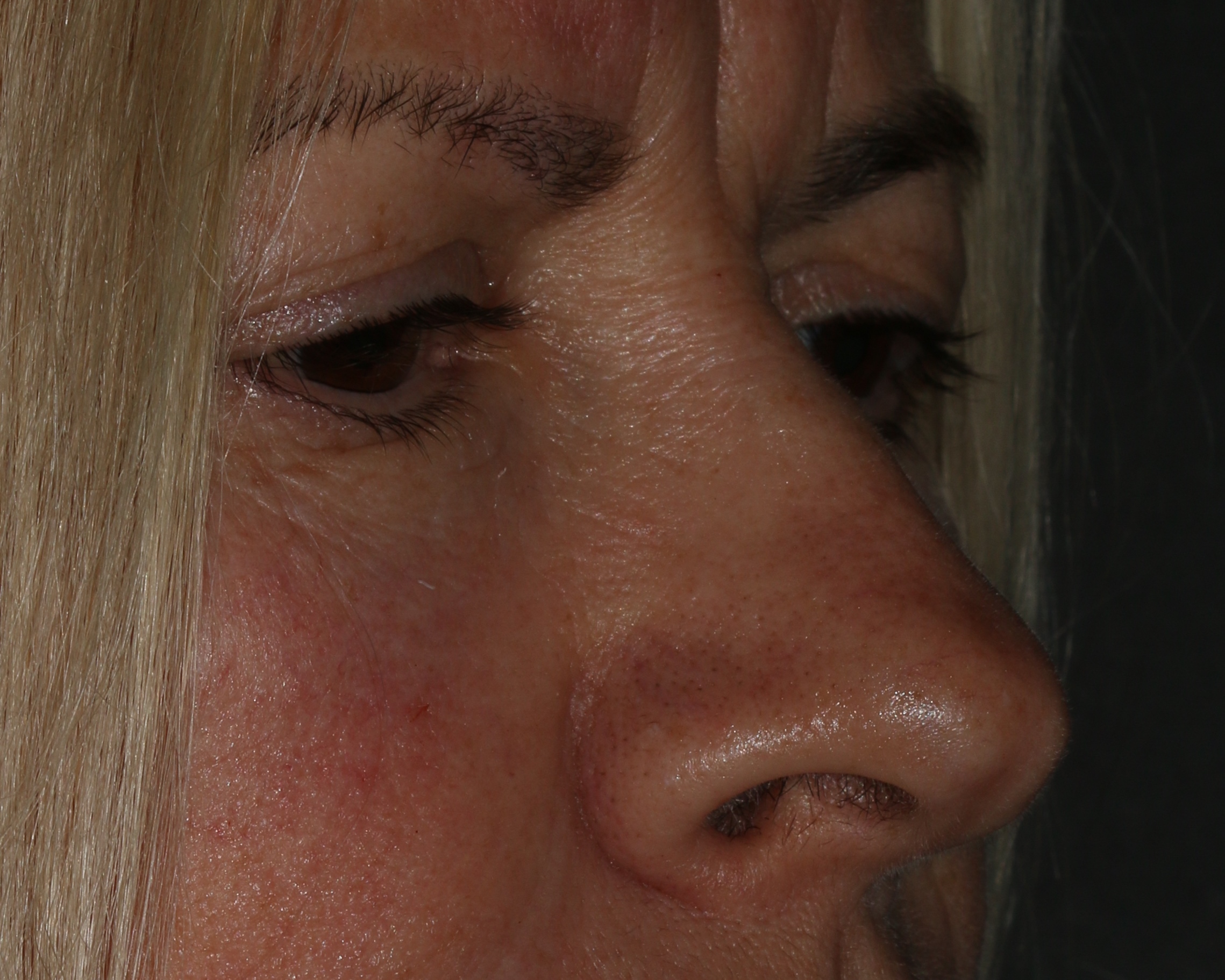 Injectable Filler - Before & After - Dr. Placik