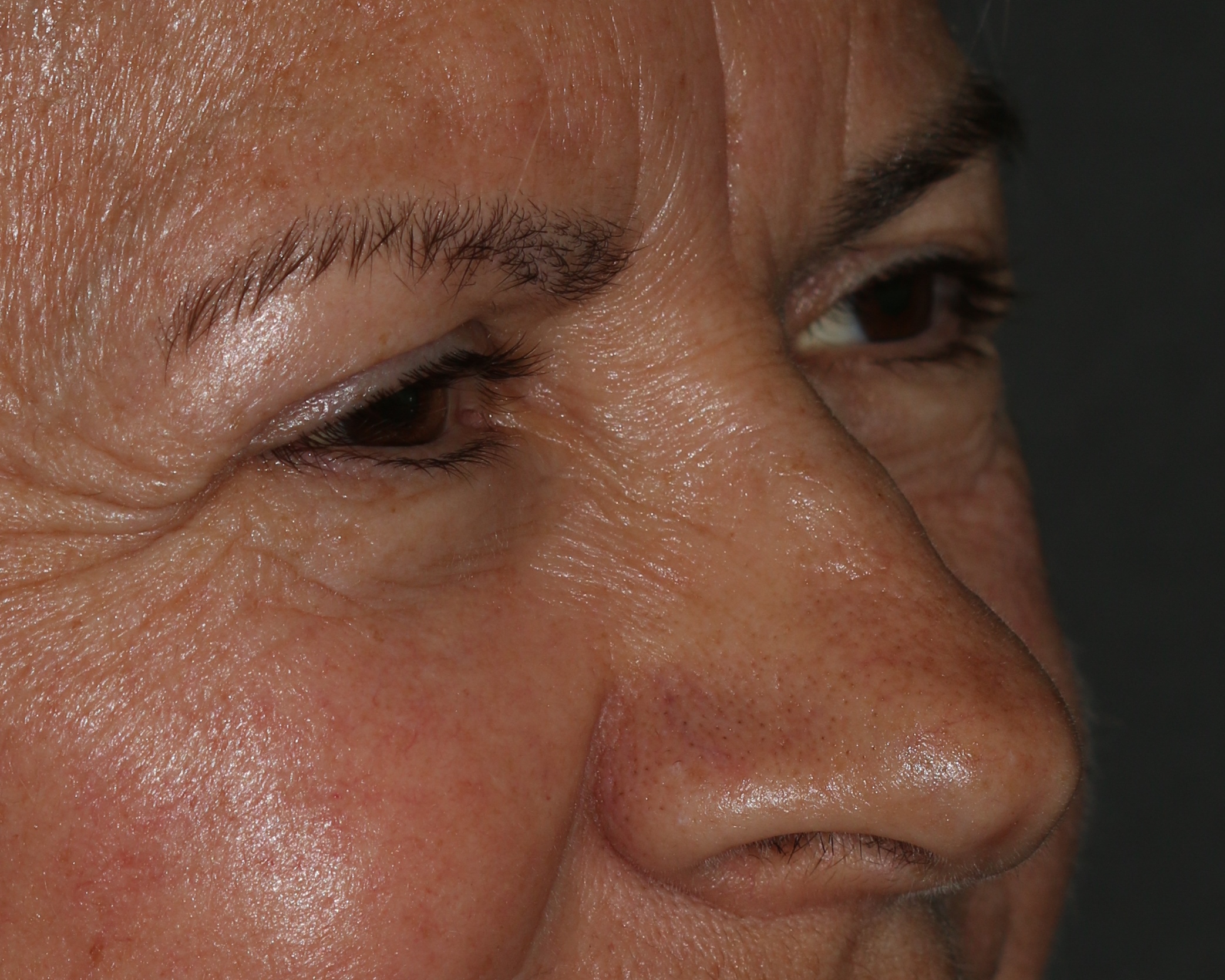 Injectable Filler - Before & After - Dr. Placik