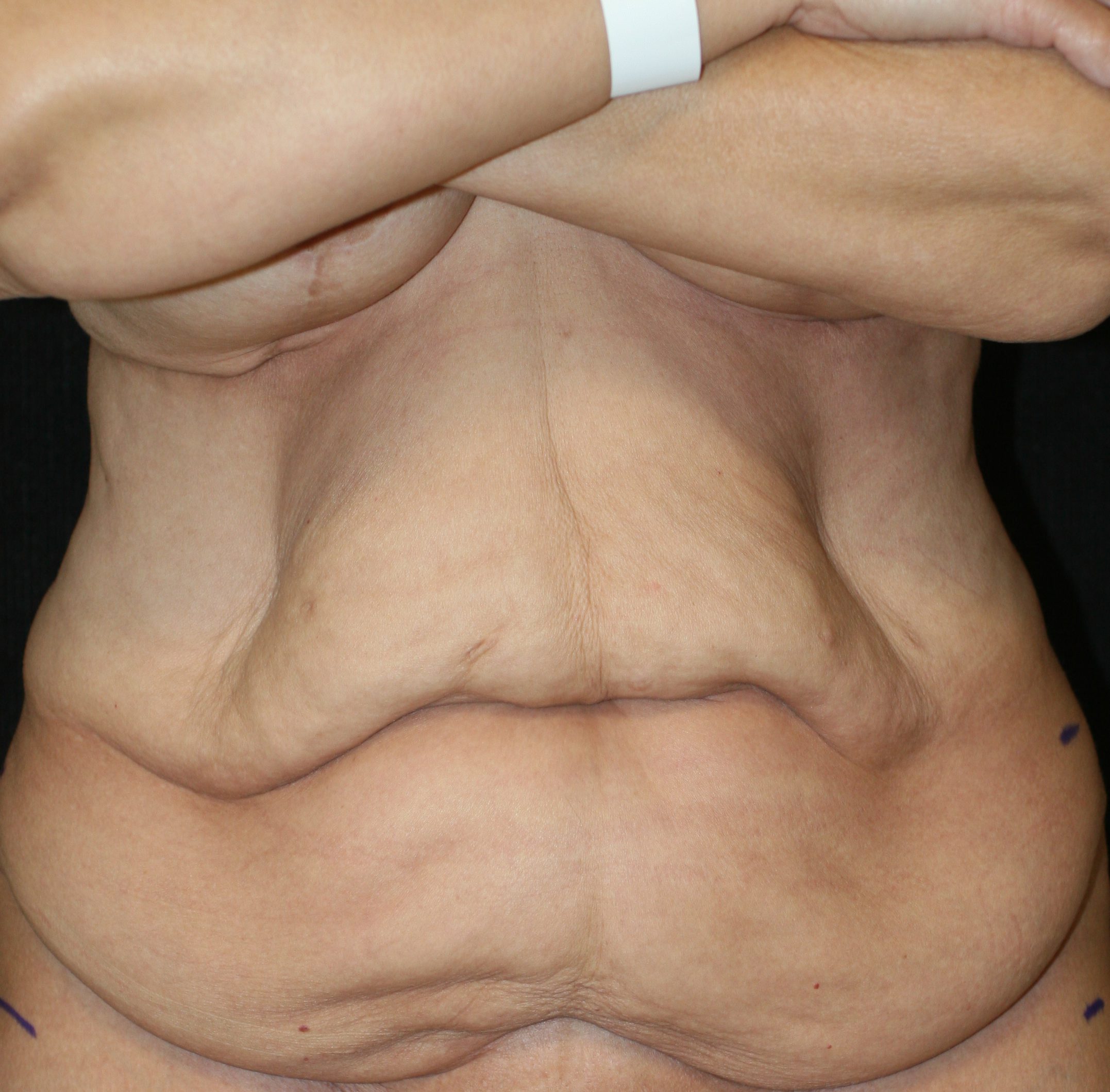 Tummy Tuck - Before & After - Dr. Placik