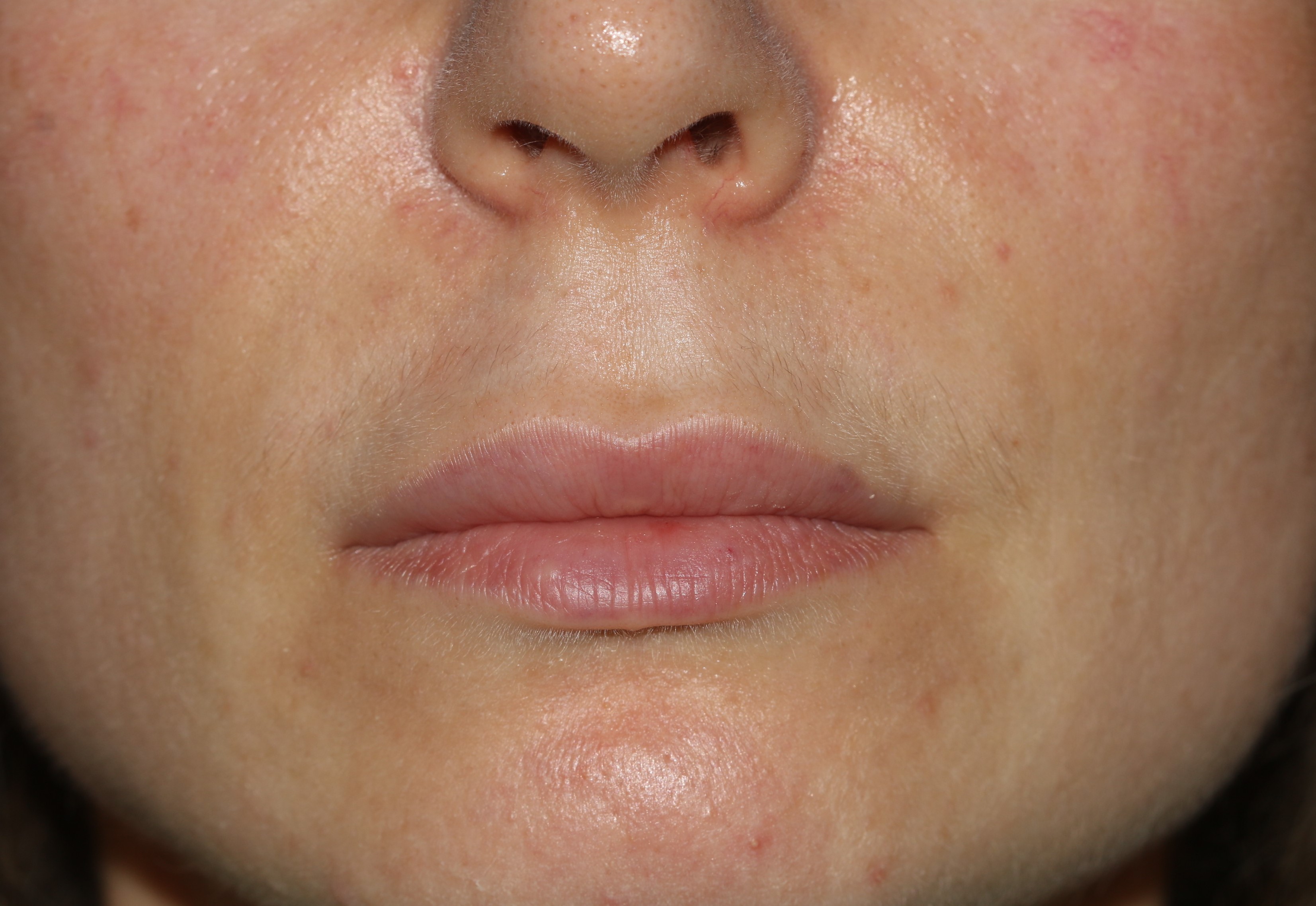 Injectable Filler - Before & After - Dr. Placik