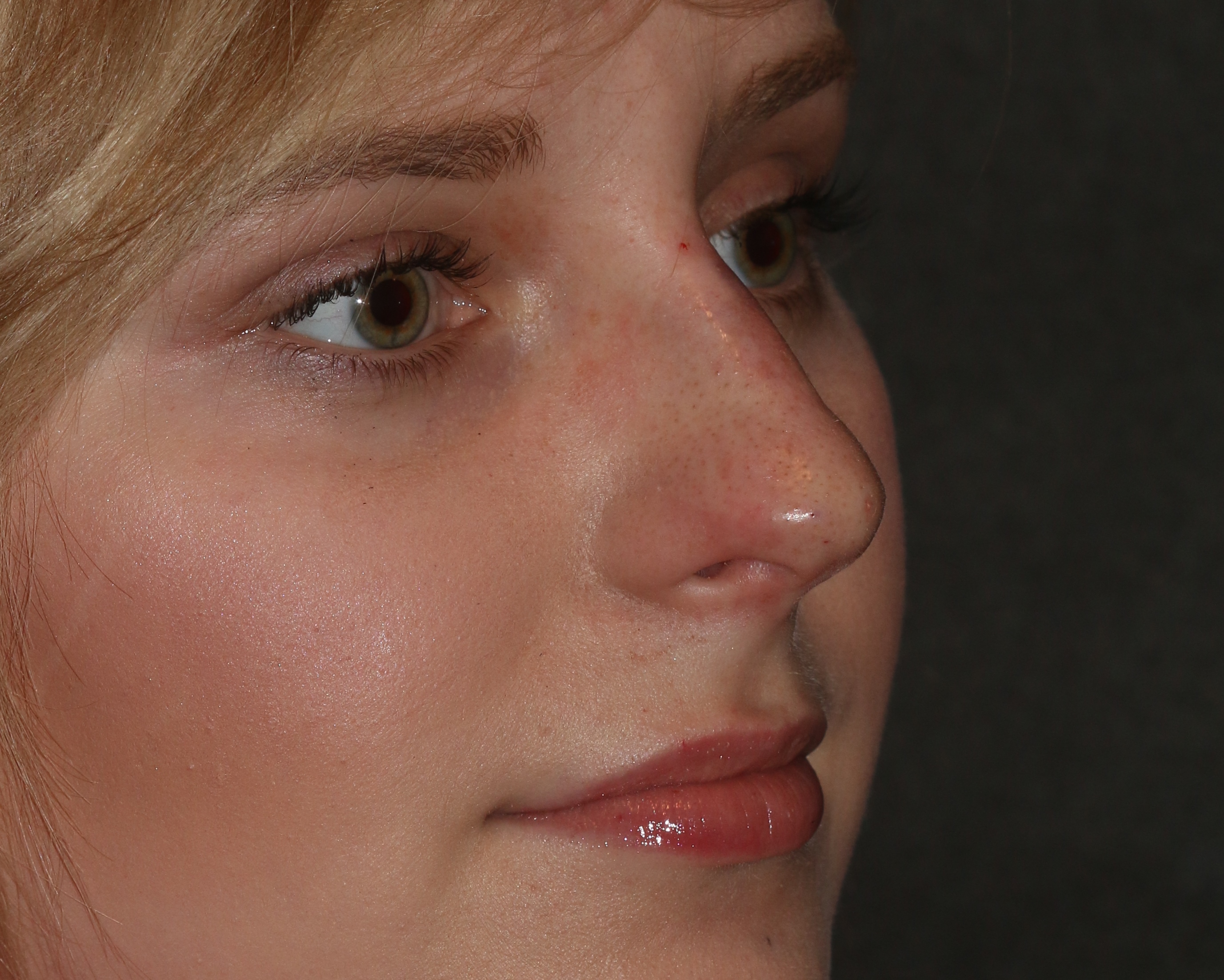 Non-Surgical Rhinoplasty - Before & After - Dr. Placik