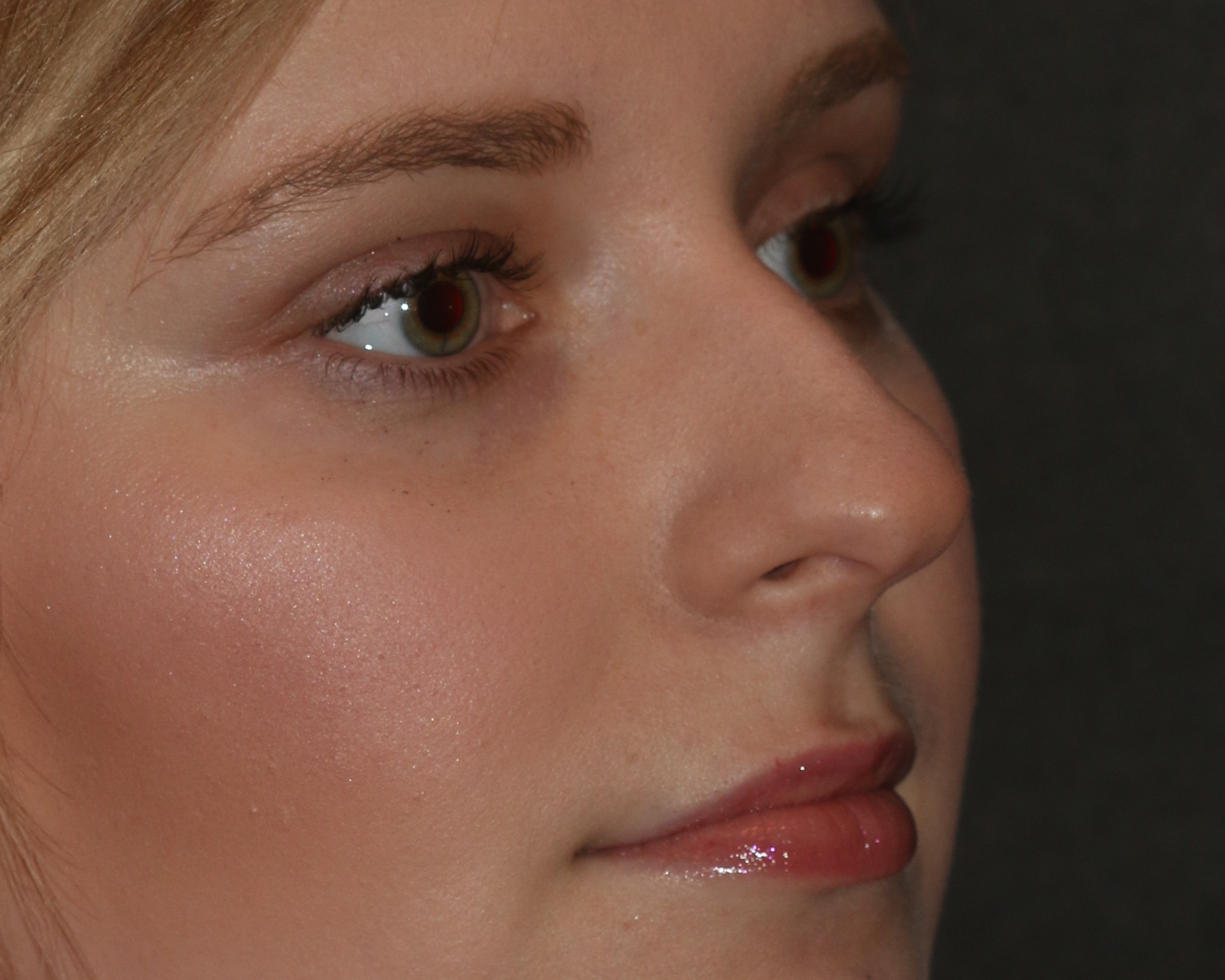 Non-Surgical Rhinoplasty - Before & After - Dr. Placik