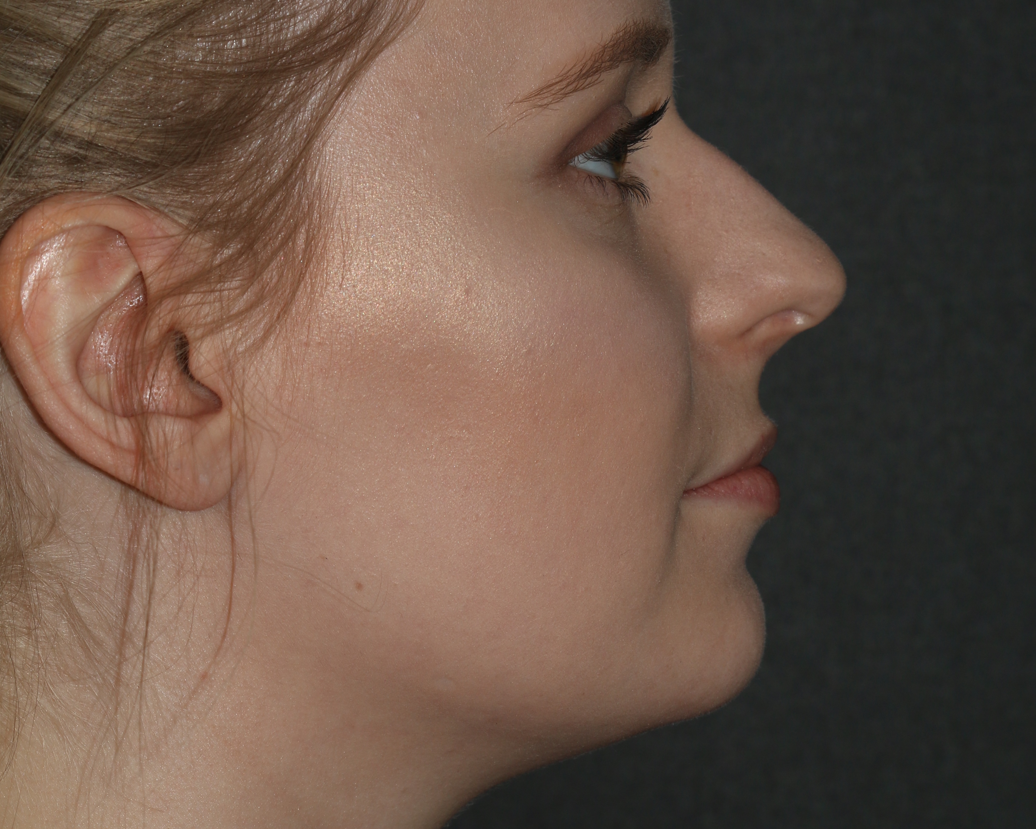 Kybella - Before & After - Dr. Placik