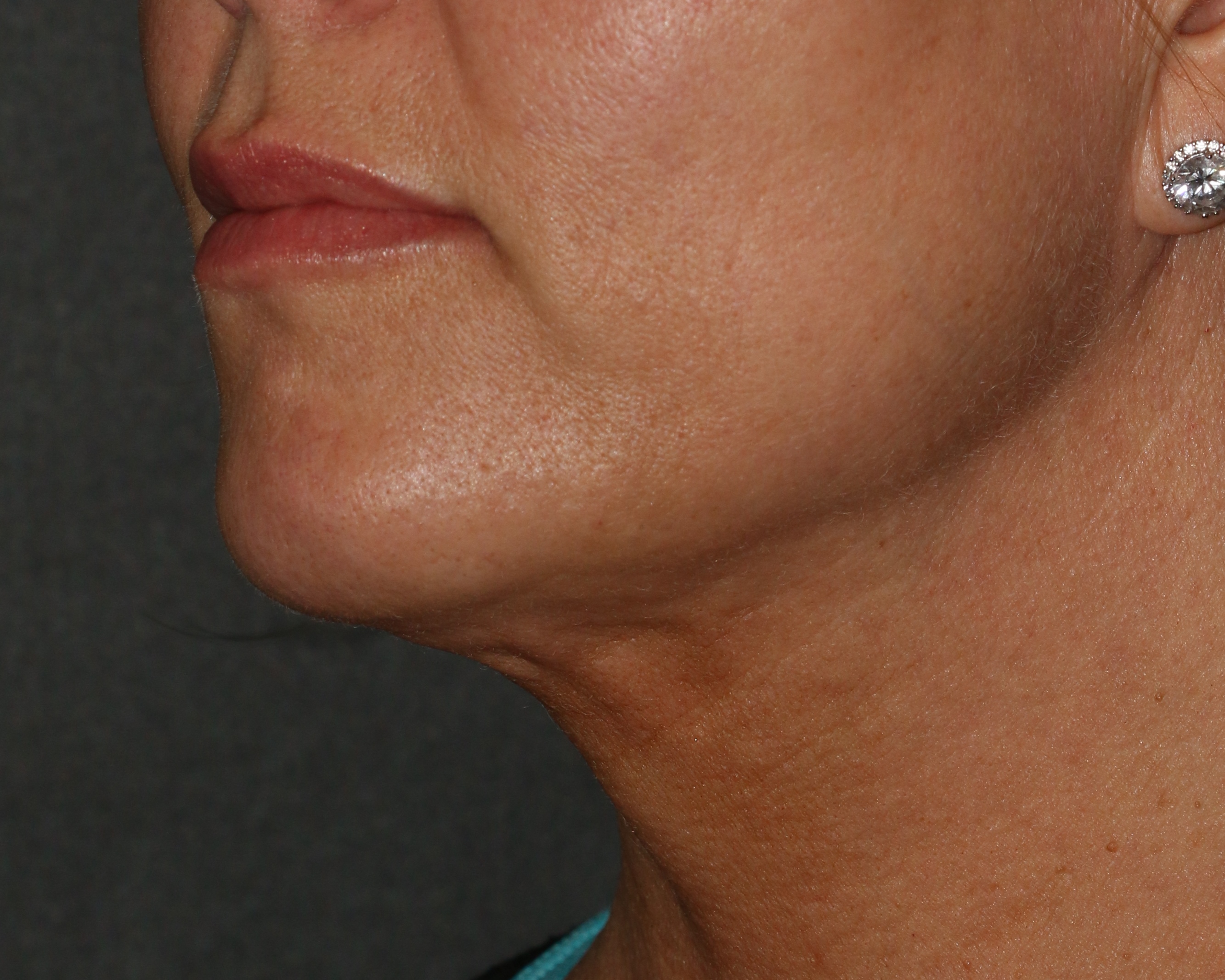 Lipoinjections to Various Facial Areas - Before & After - Dr. Placik