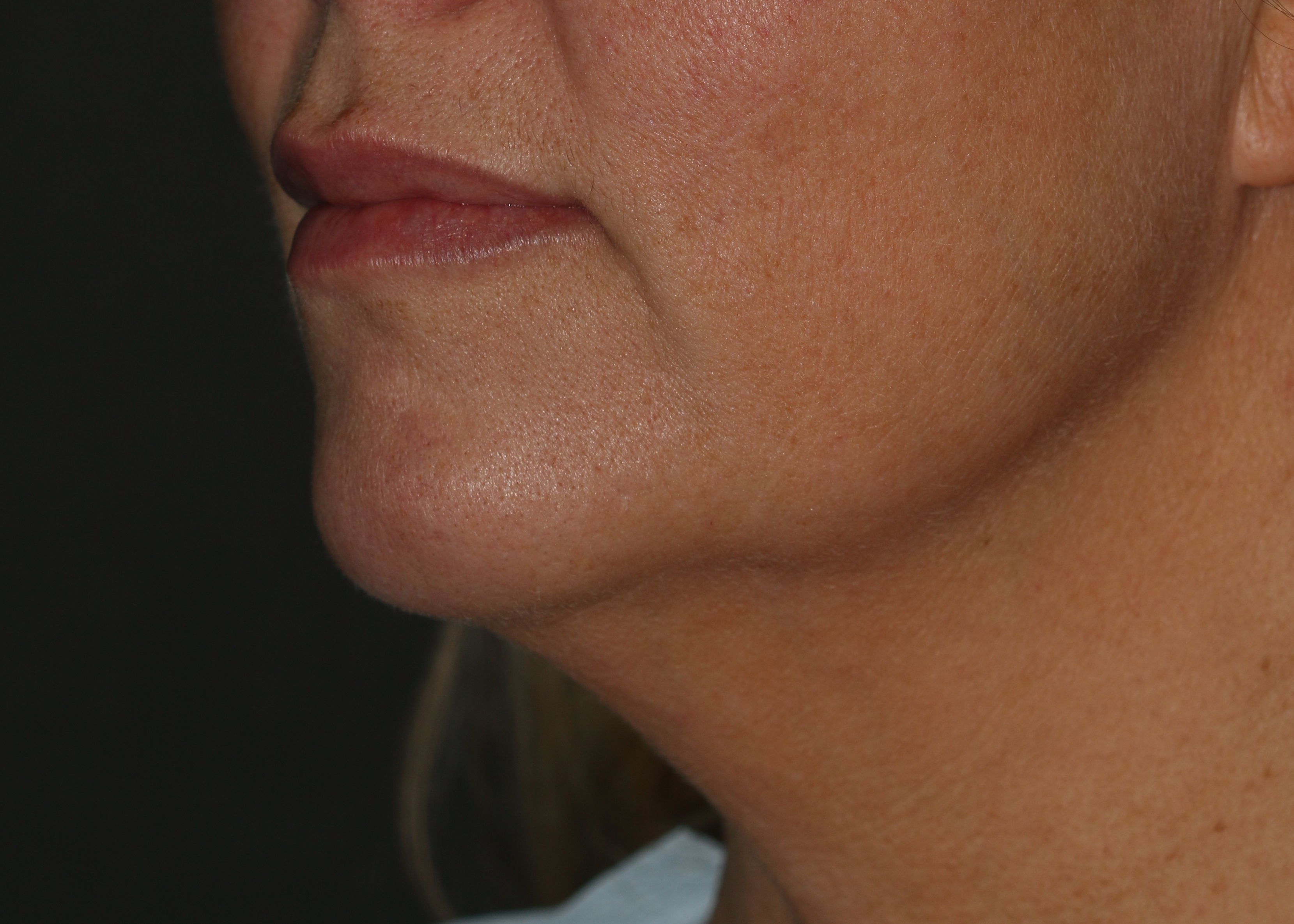 Lipoinjections to Various Facial Areas - Before & After - Dr. Placik