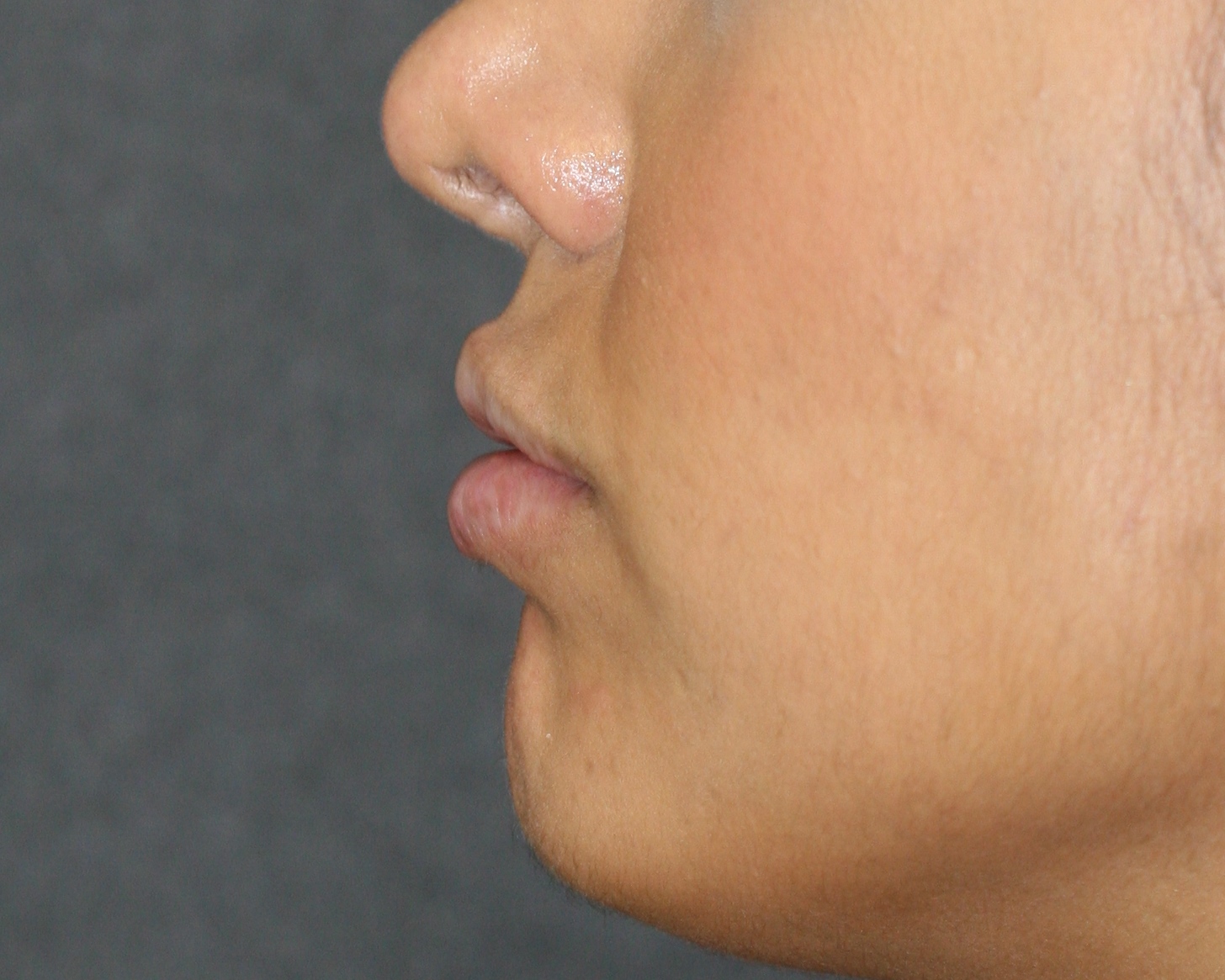 Lip Enhancement - Before & After - Dr. Placik