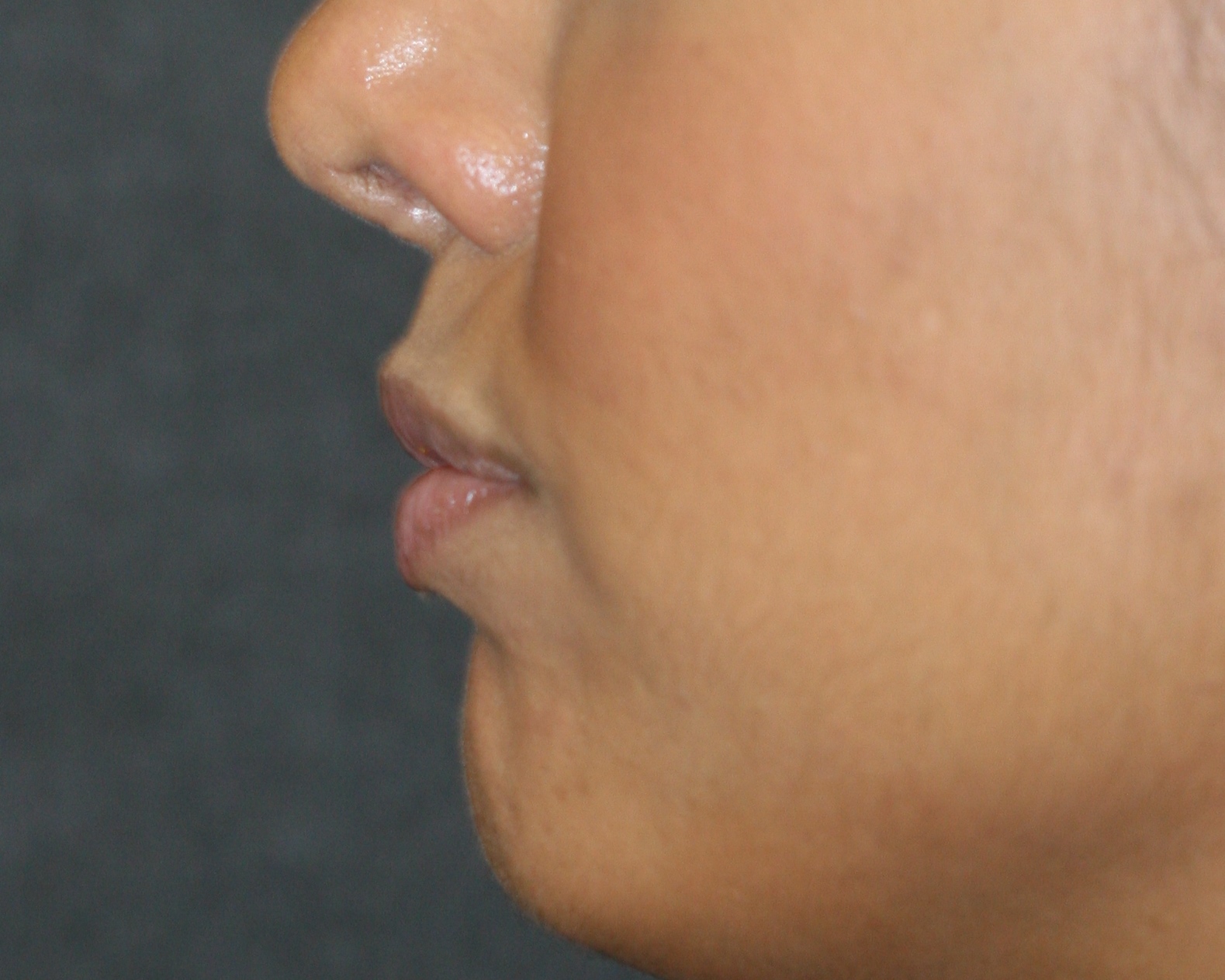 Lip Enhancement - Before & After - Dr. Placik