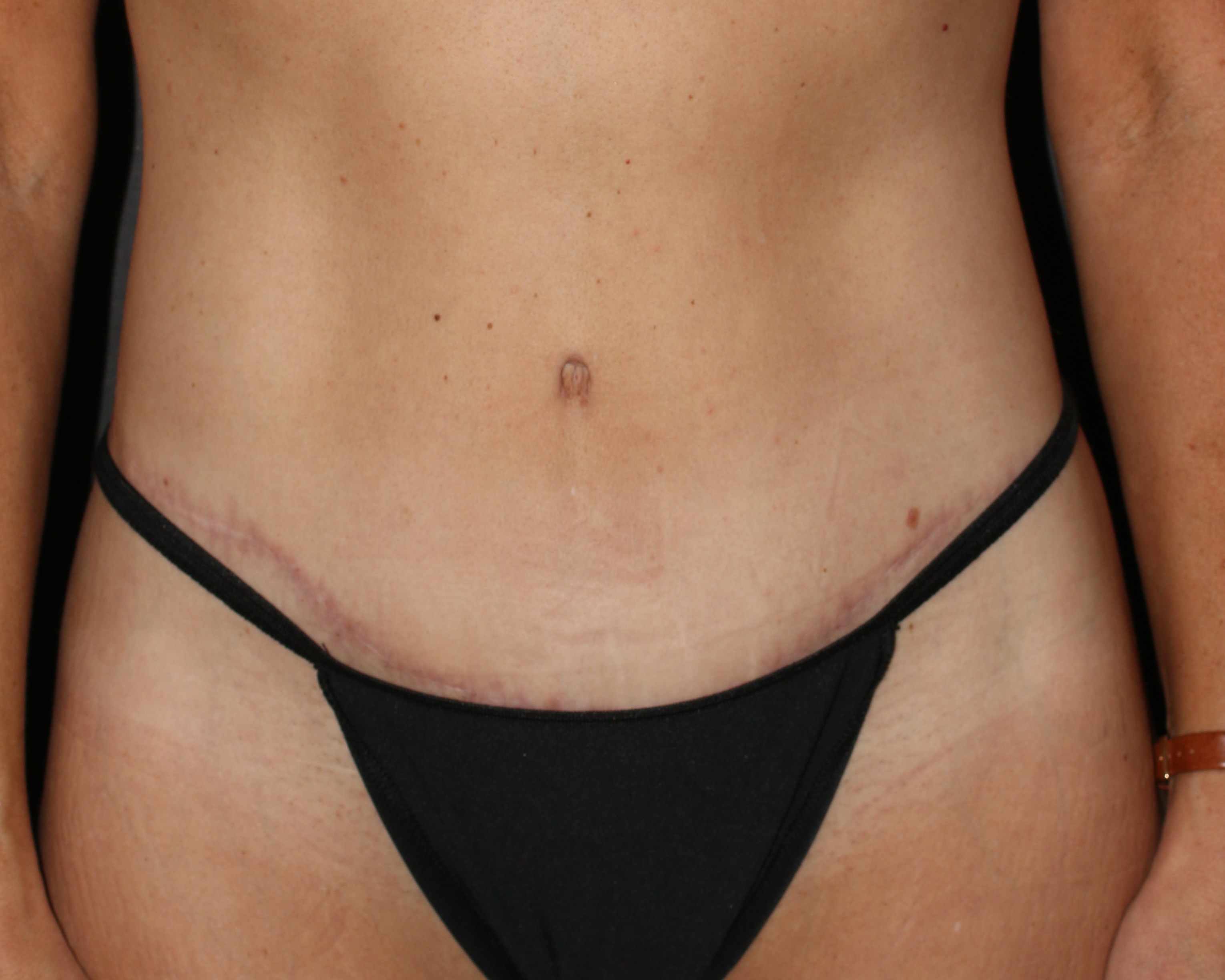 Tummy Tuck - Before & After - Dr. Placik