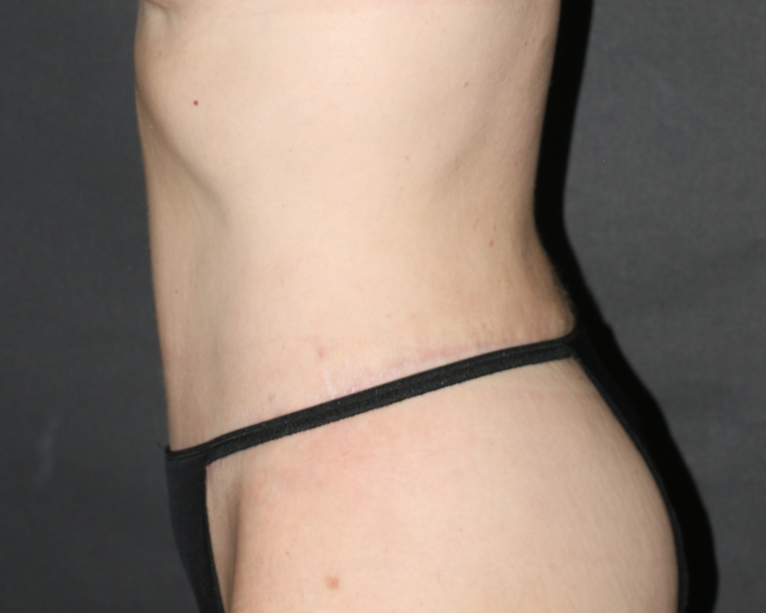 Tummy Tuck Chicago