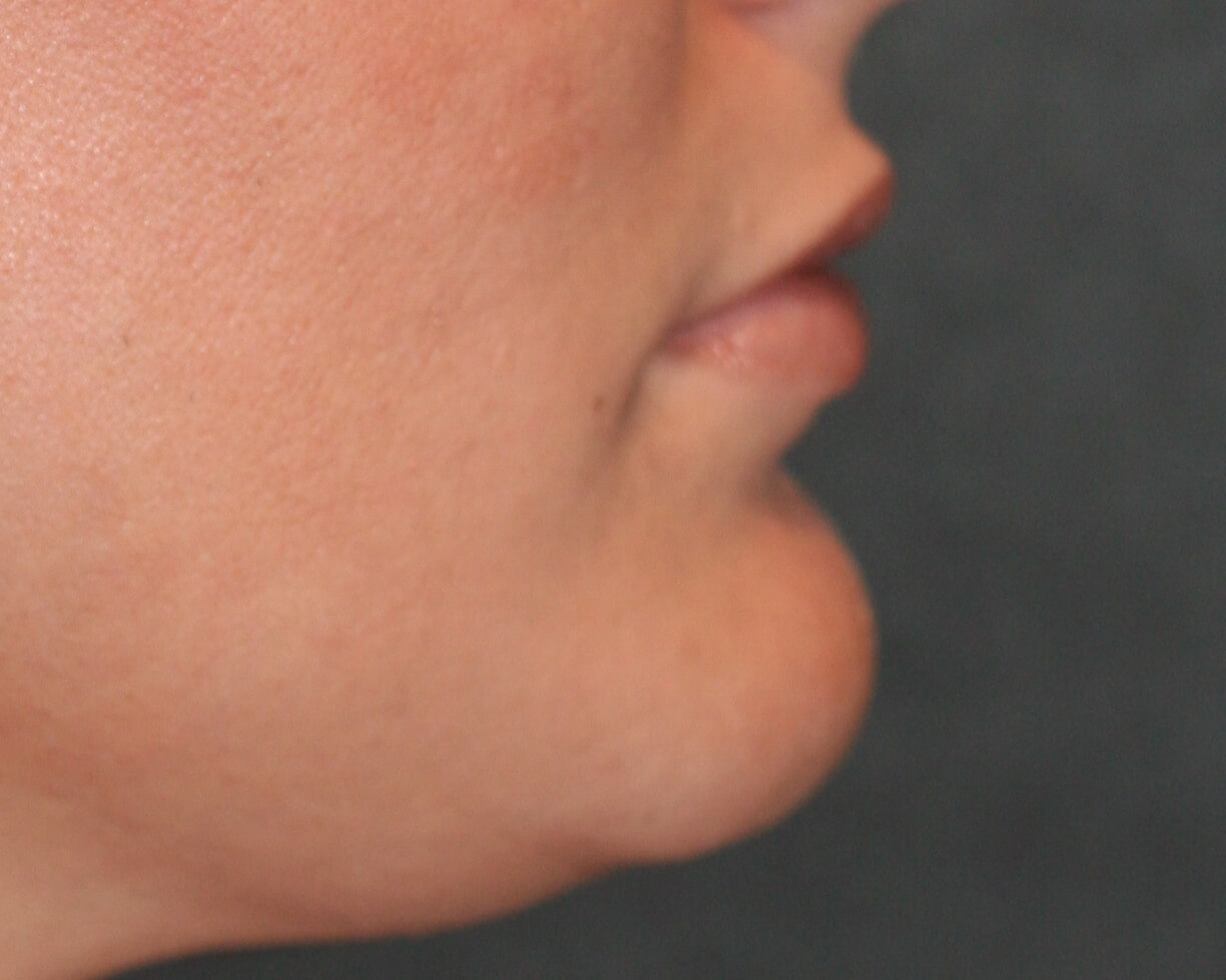 Lip Enhancement - Before & After - Dr. Placik