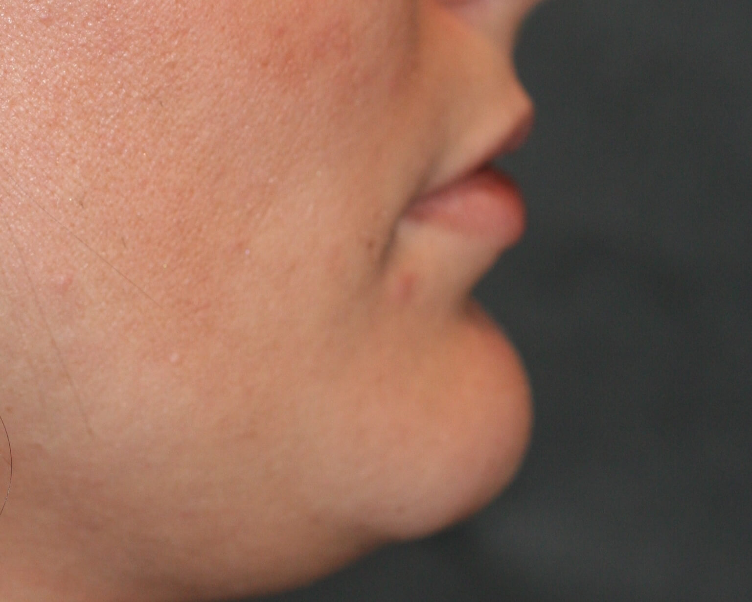 Lip Enhancement - Before & After - Dr. Placik