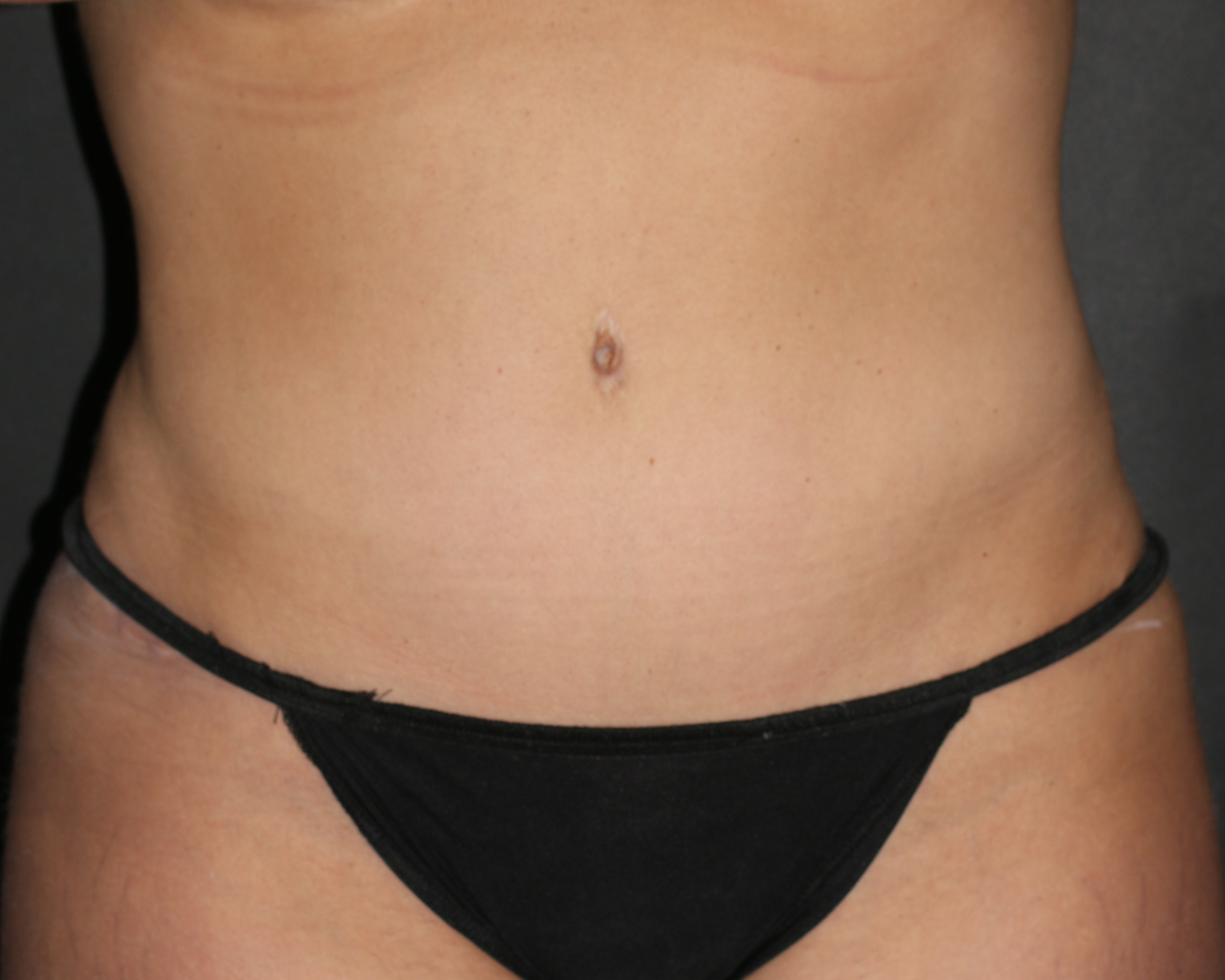 Tummy Tuck - Before & After - Dr. Placik