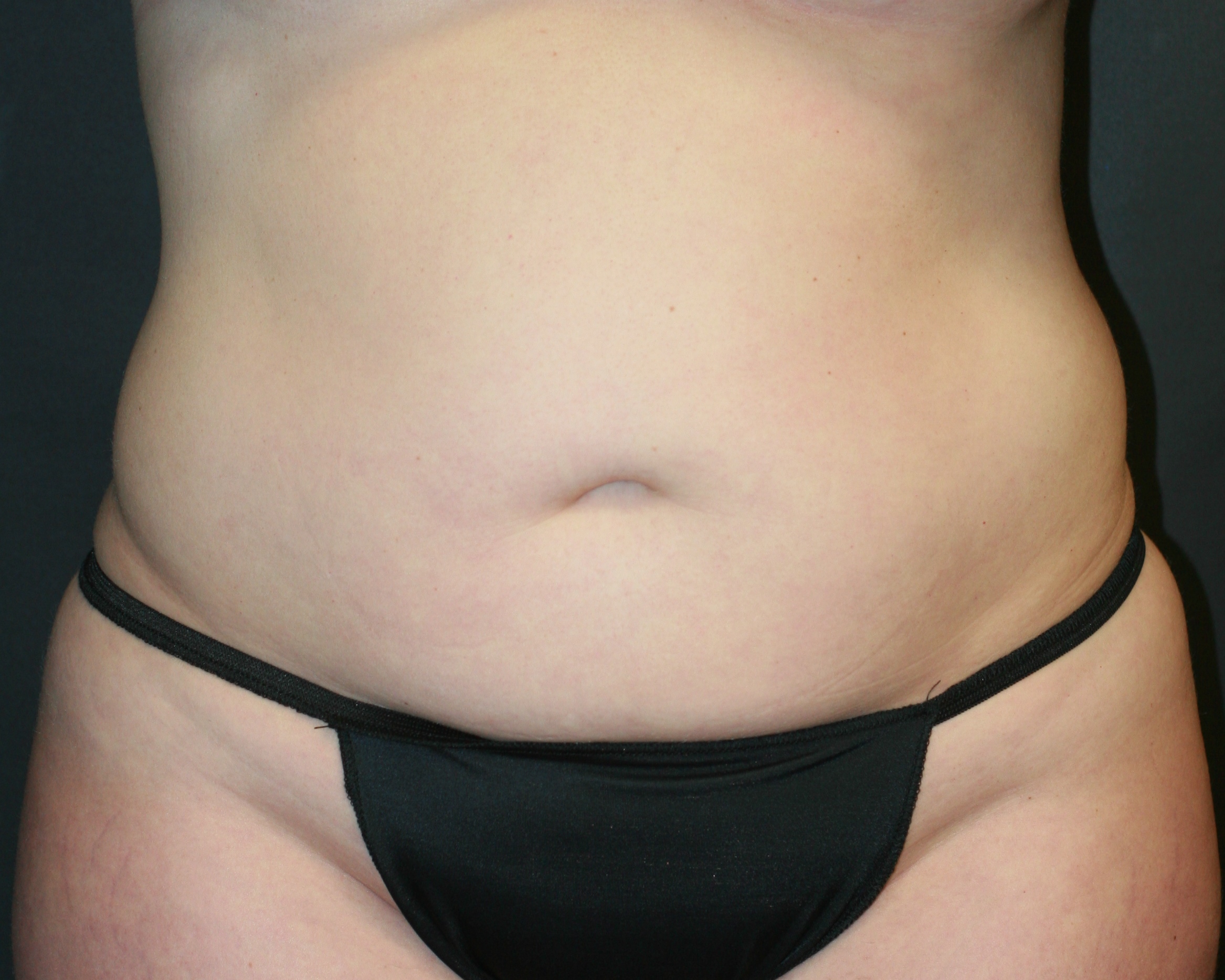 Tummy Tuck - Before & After - Dr. Placik