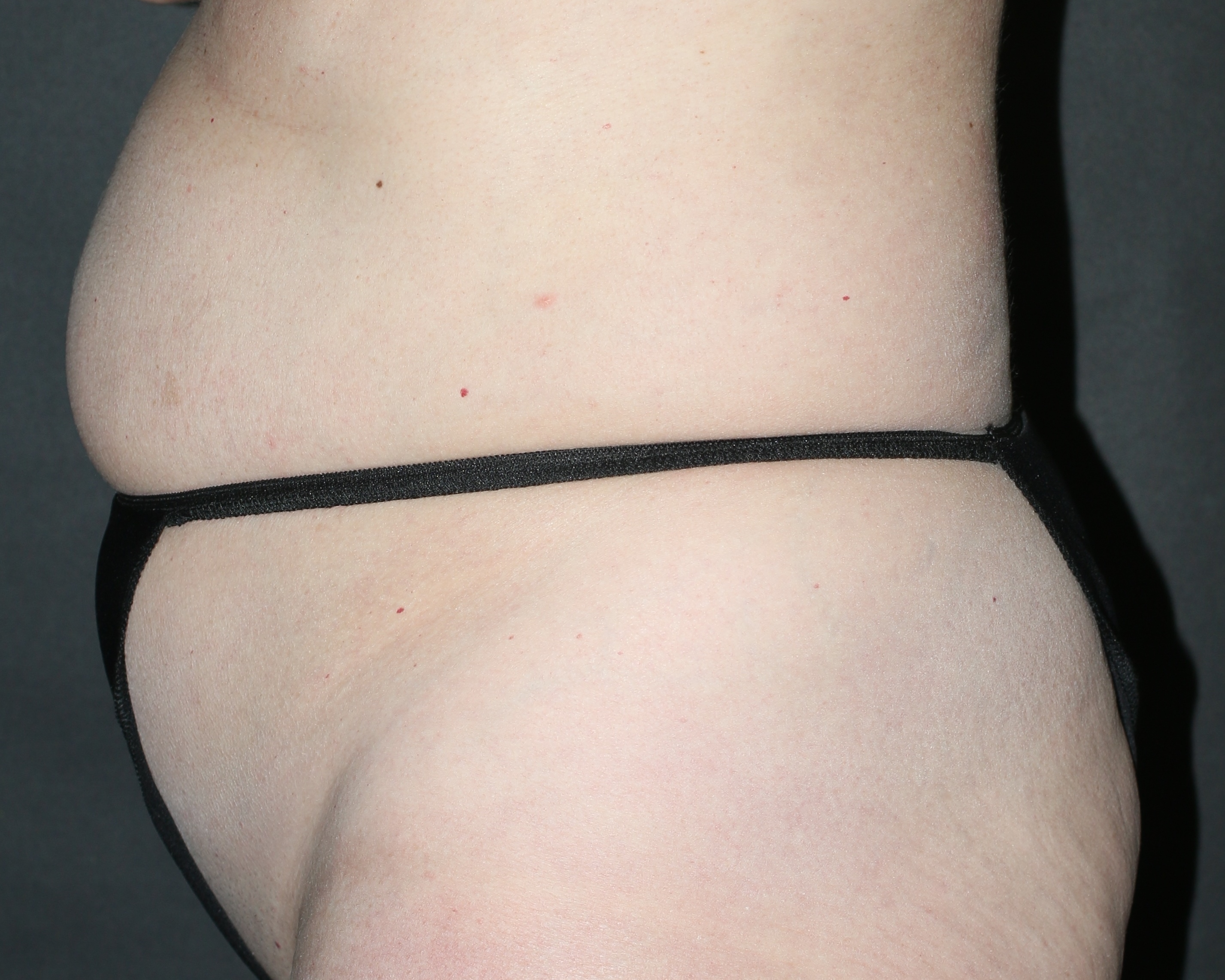 Tummy Tuck - Before & After - Dr. Placik