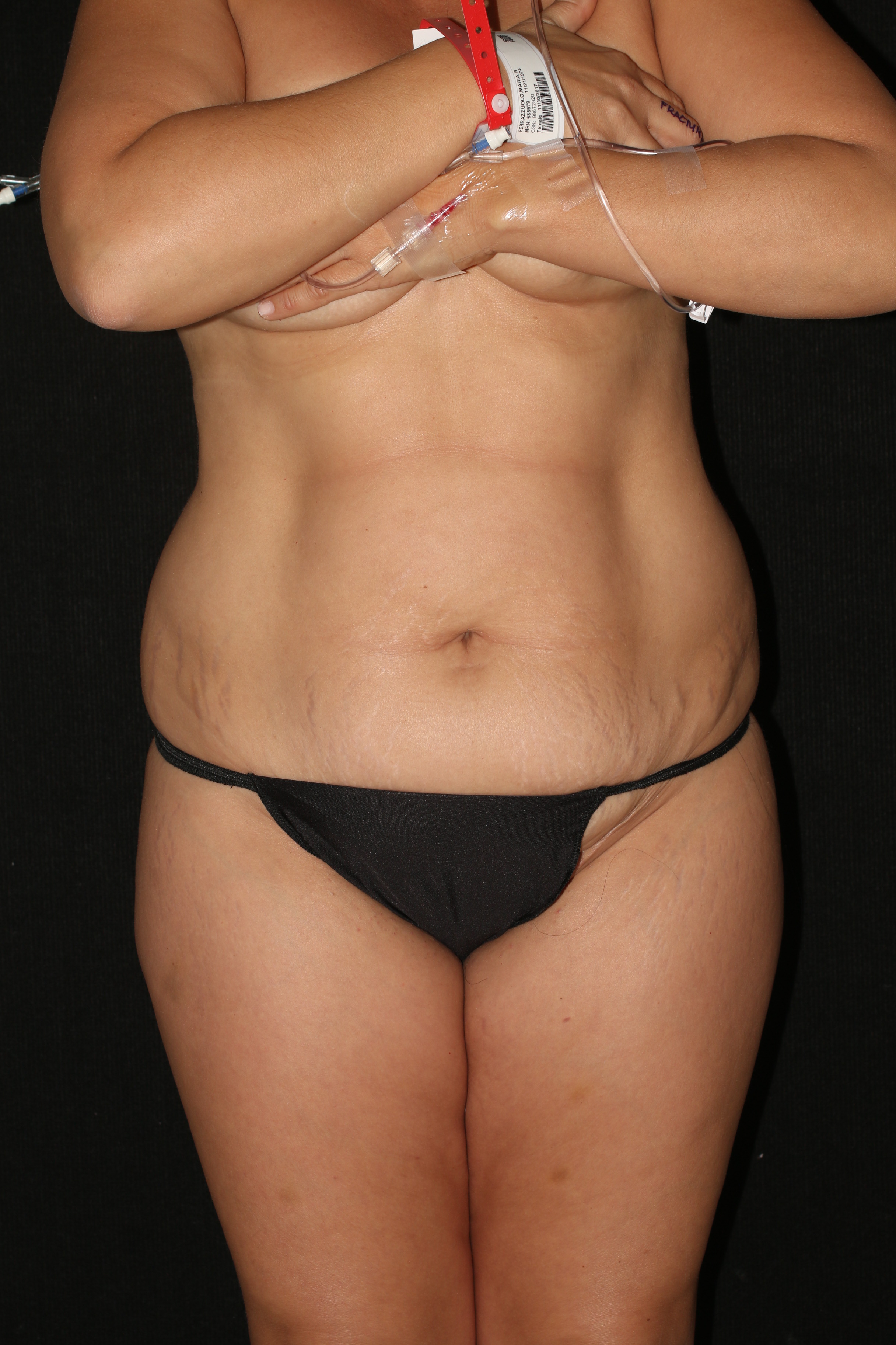 Tummy Tuck - Before & After - Dr. Placik