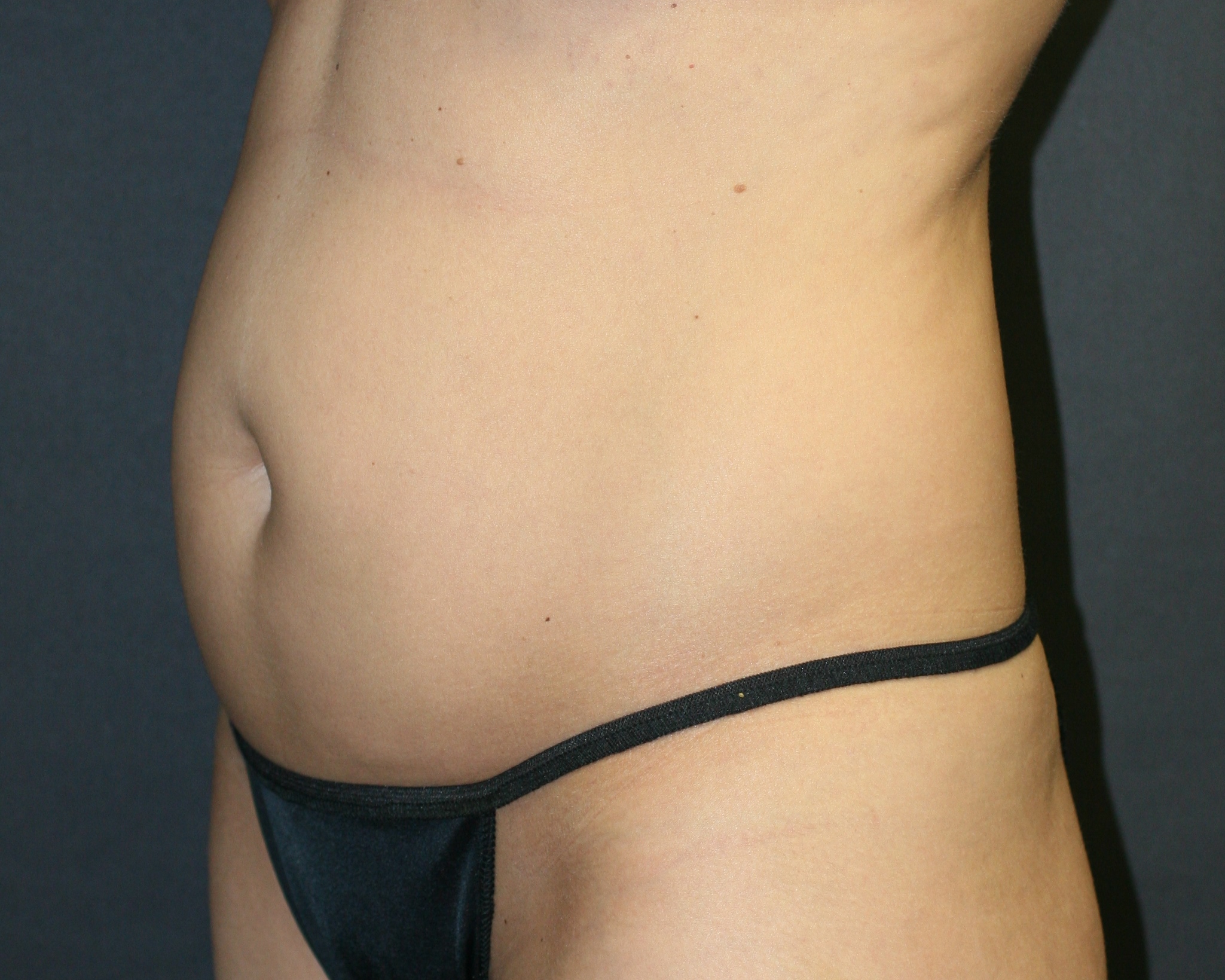 Tummy Tuck - Before & After - Dr. Placik