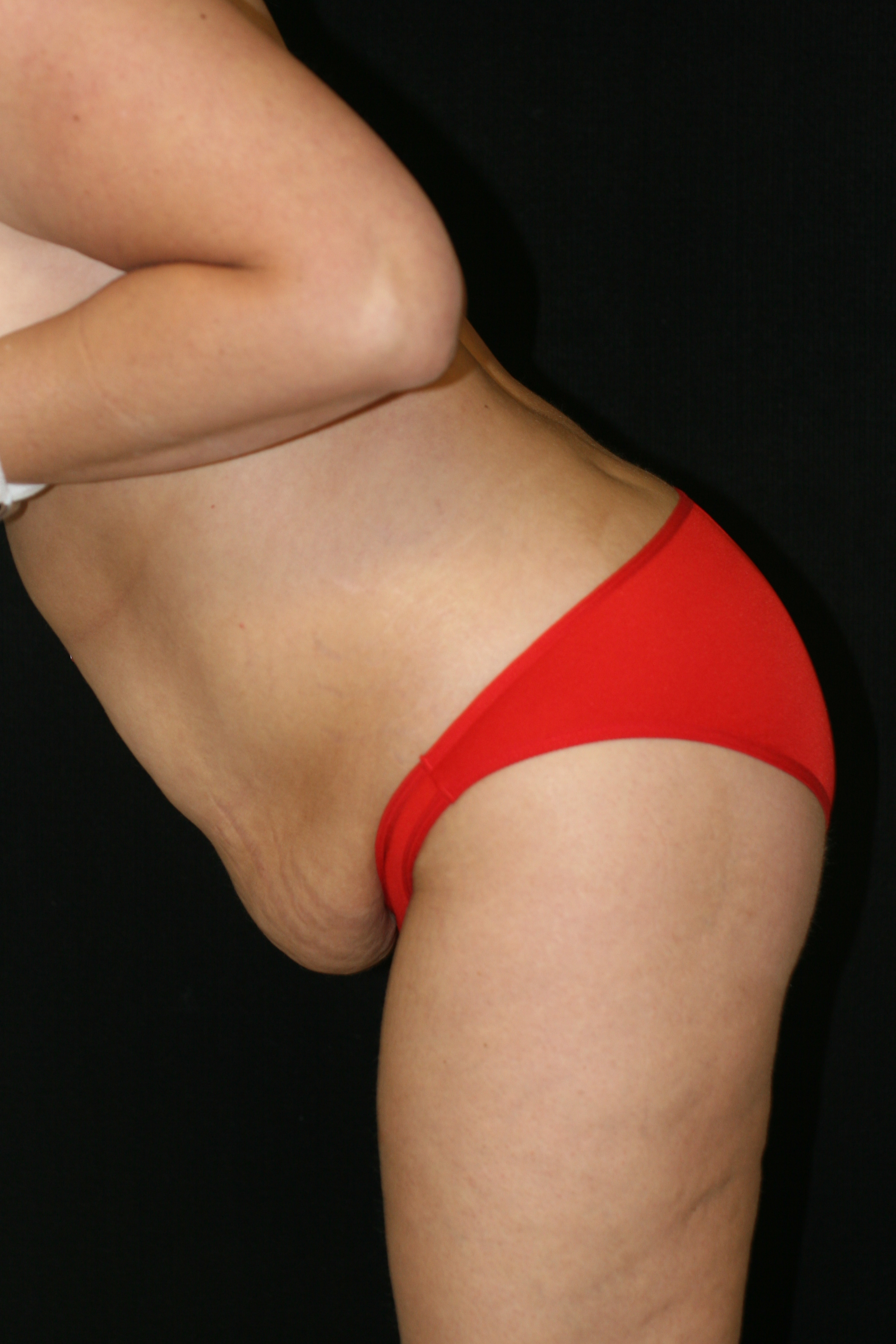 Tummy Tuck - Before & After - Dr. Placik