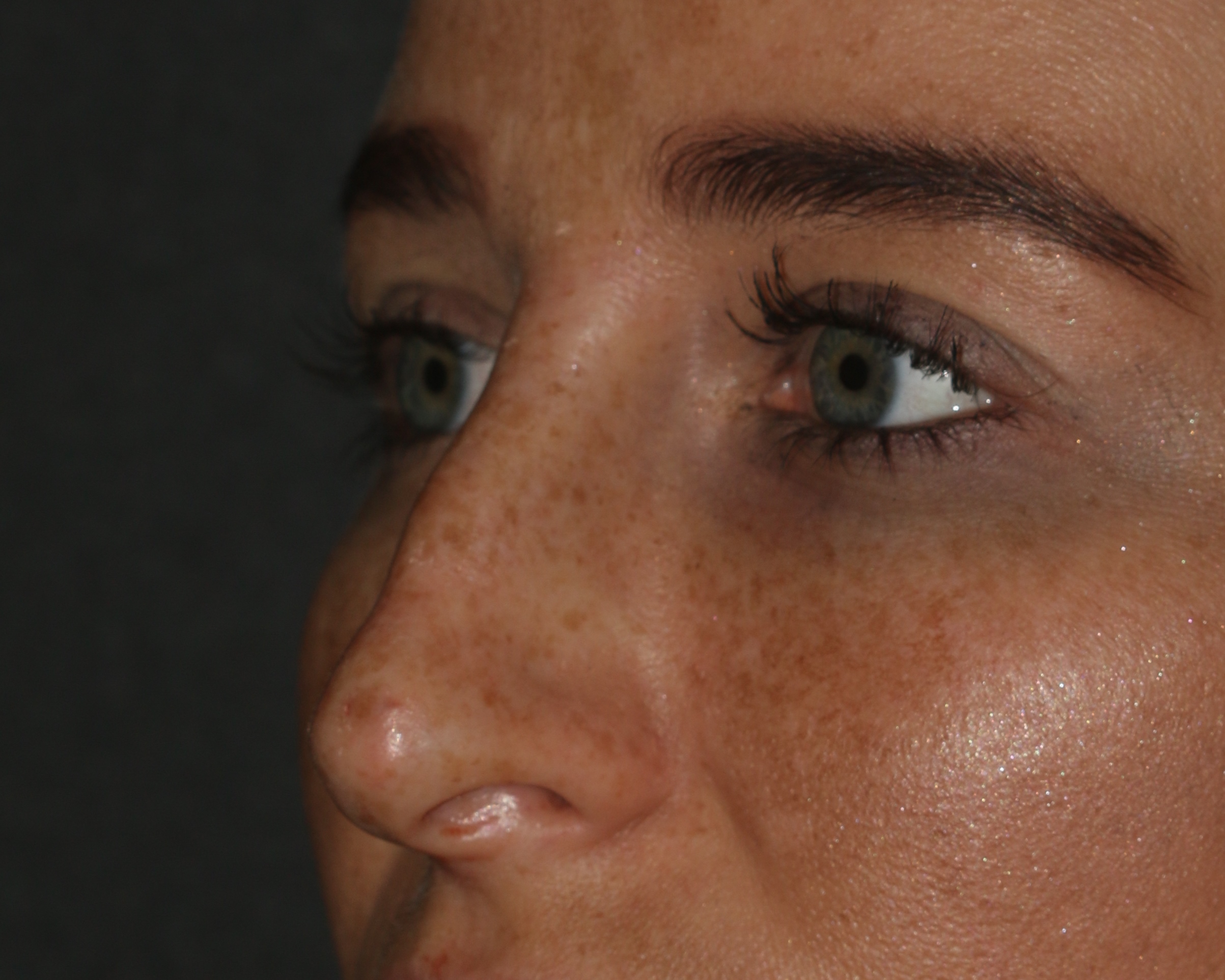 Non-Surgical Rhinoplasty Chicago