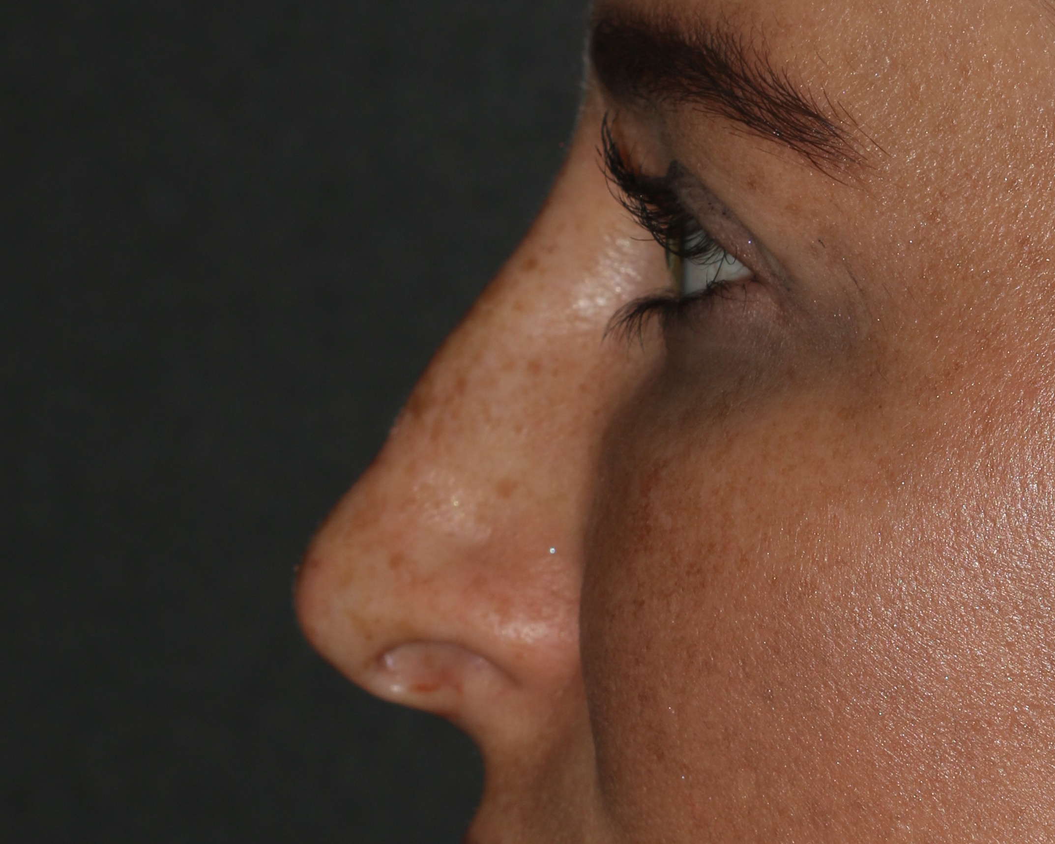 Non-Surgical Rhinoplasty - Before & After - Dr. Placik