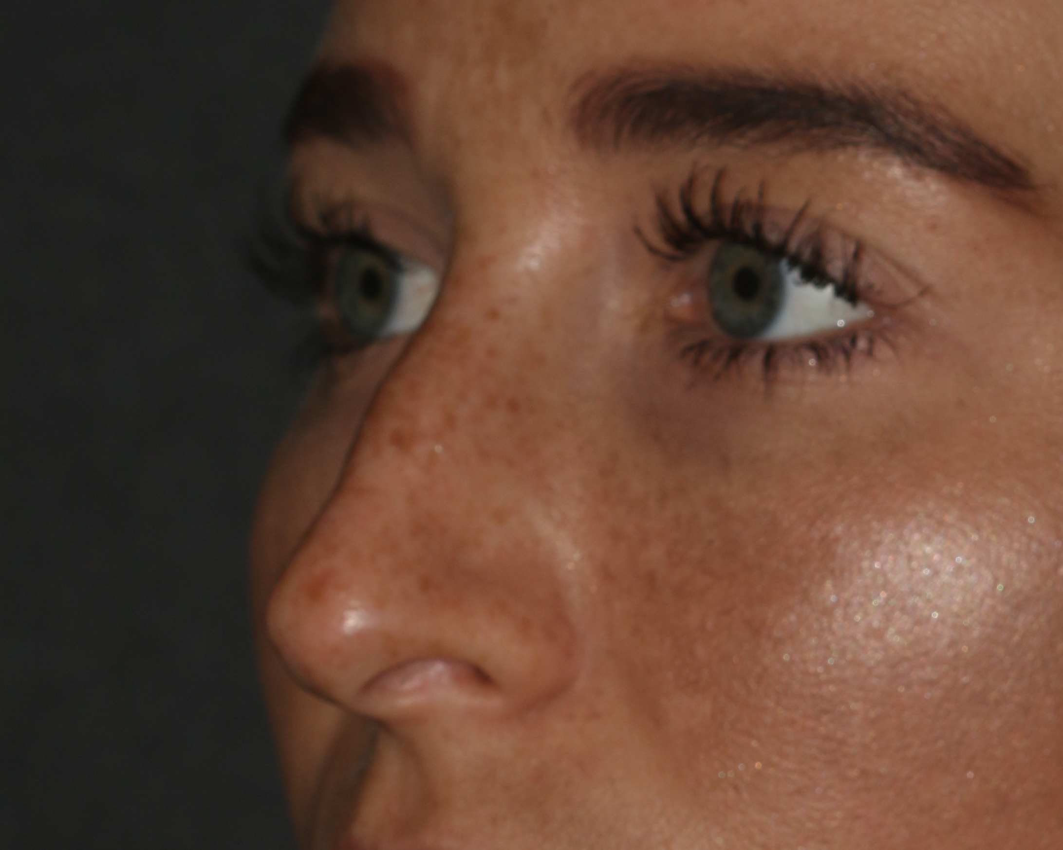 Non-Surgical Rhinoplasty Chicago