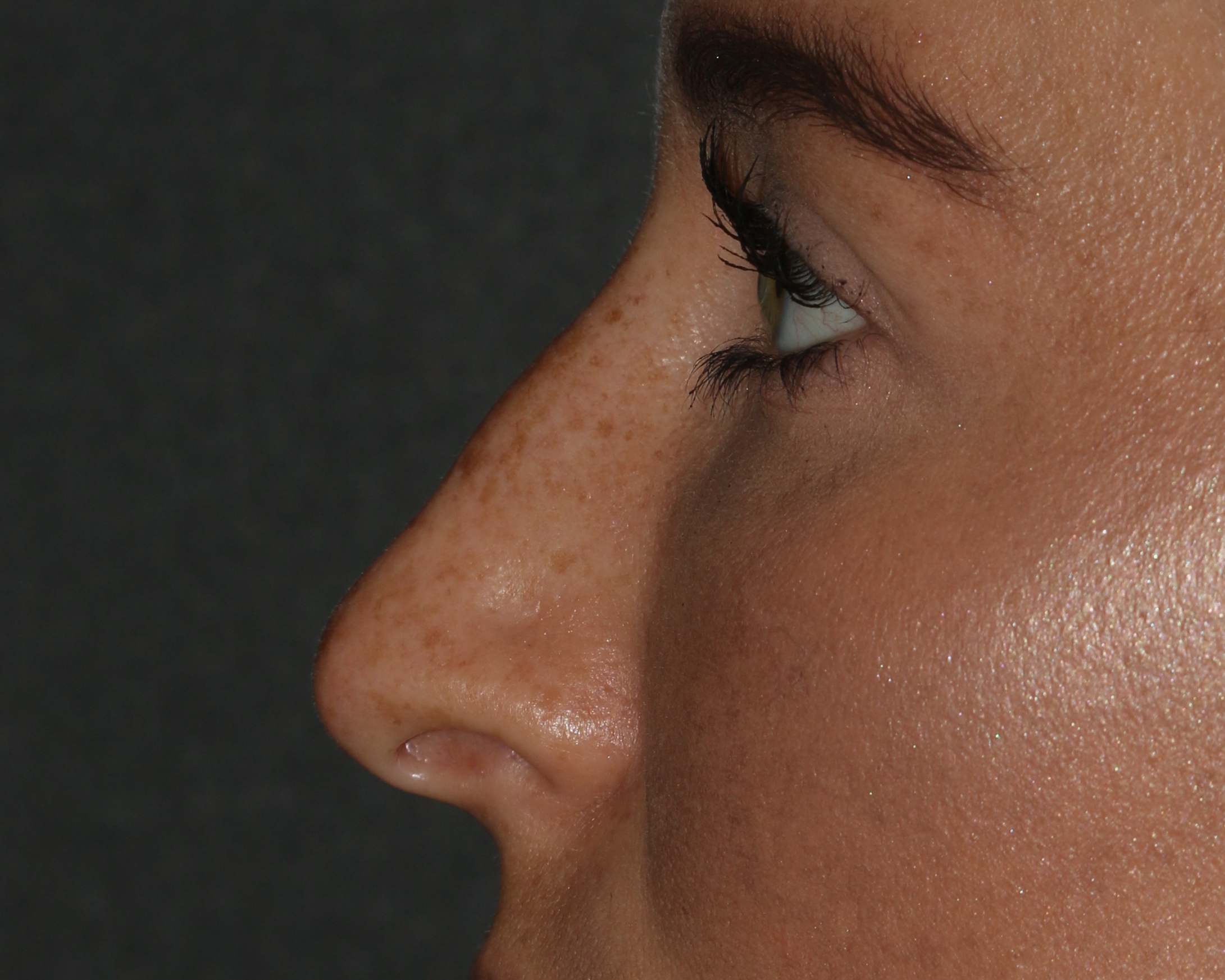 Non-Surgical Rhinoplasty - Before & After - Dr. Placik