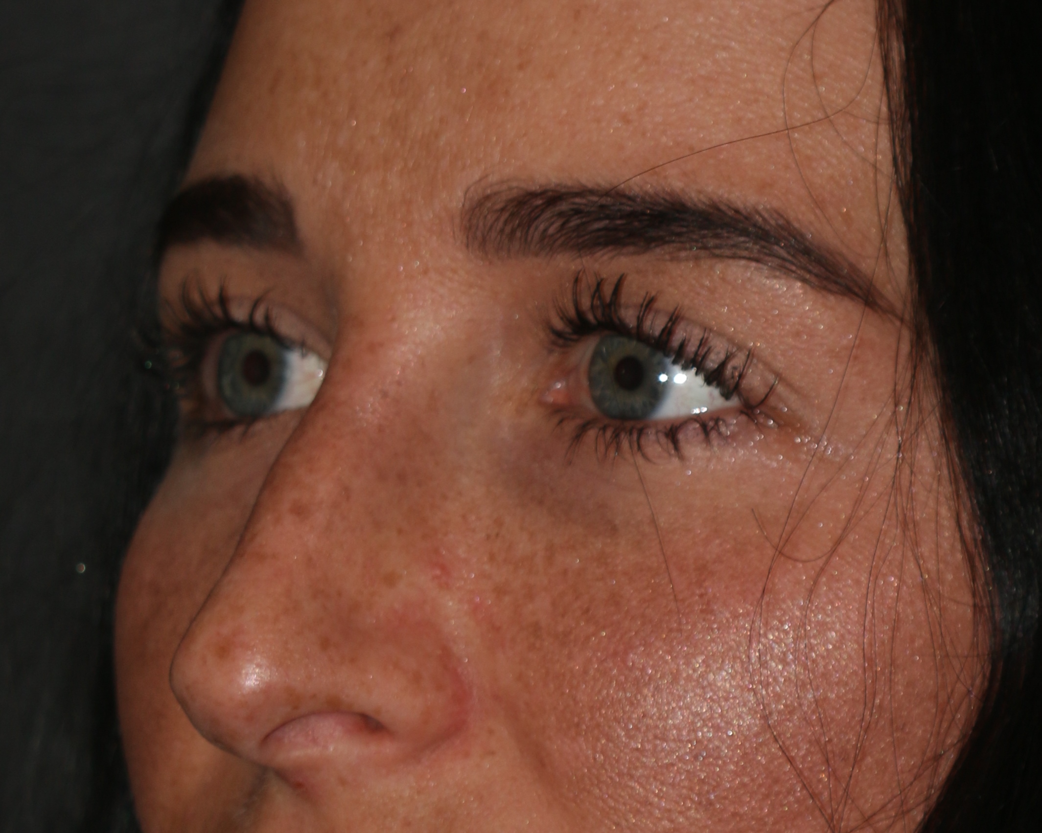 Injectable Filler Chicago