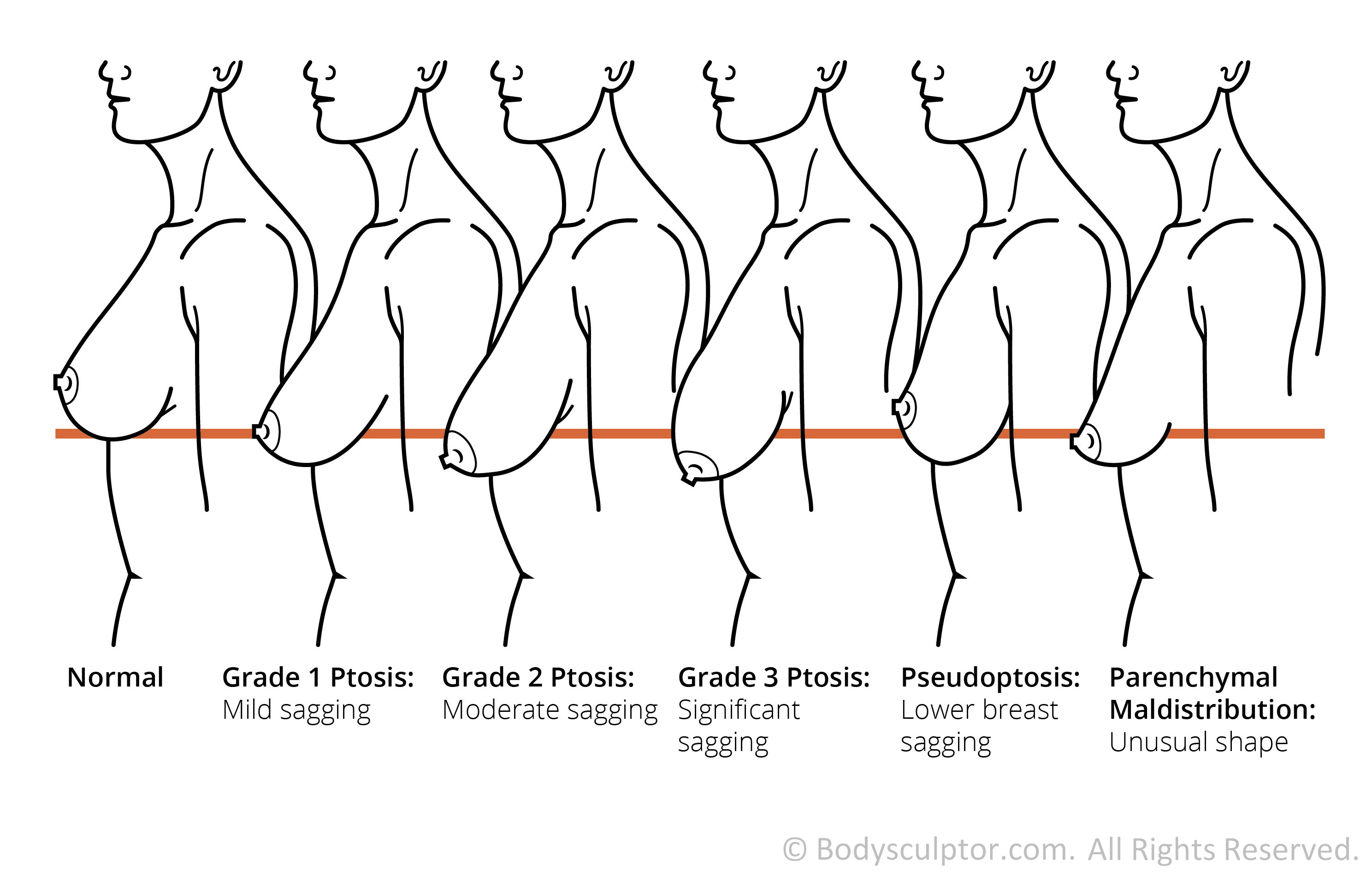 Diagram of Breast Sagging before Breast Lift