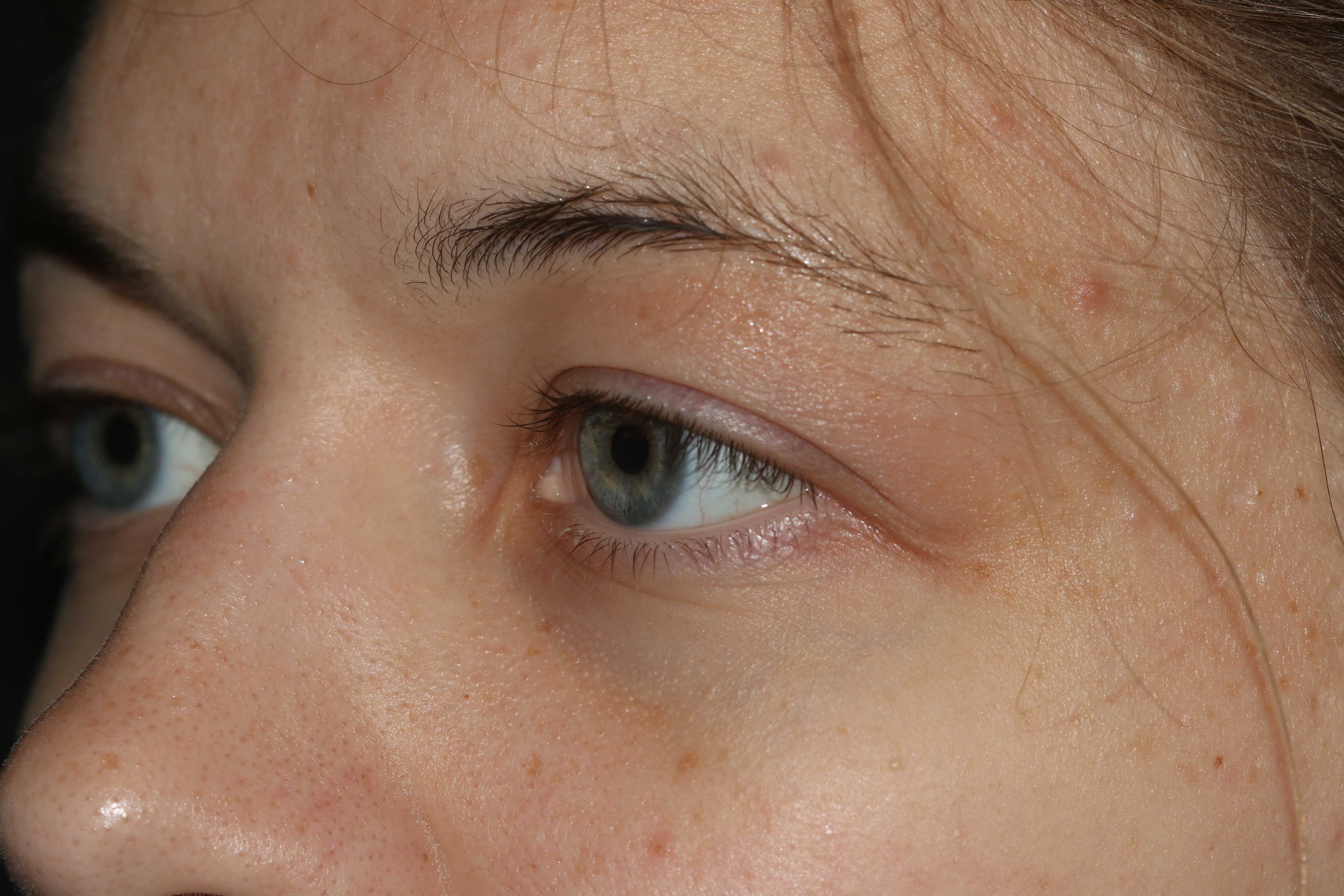 Eyelid Surgery - Before & After - Dr. Placik