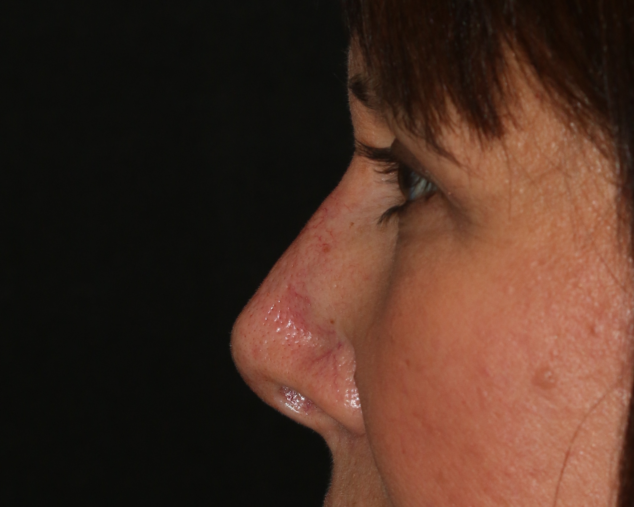 Non-Surgical Rhinoplasty utilizing Restylane Filler