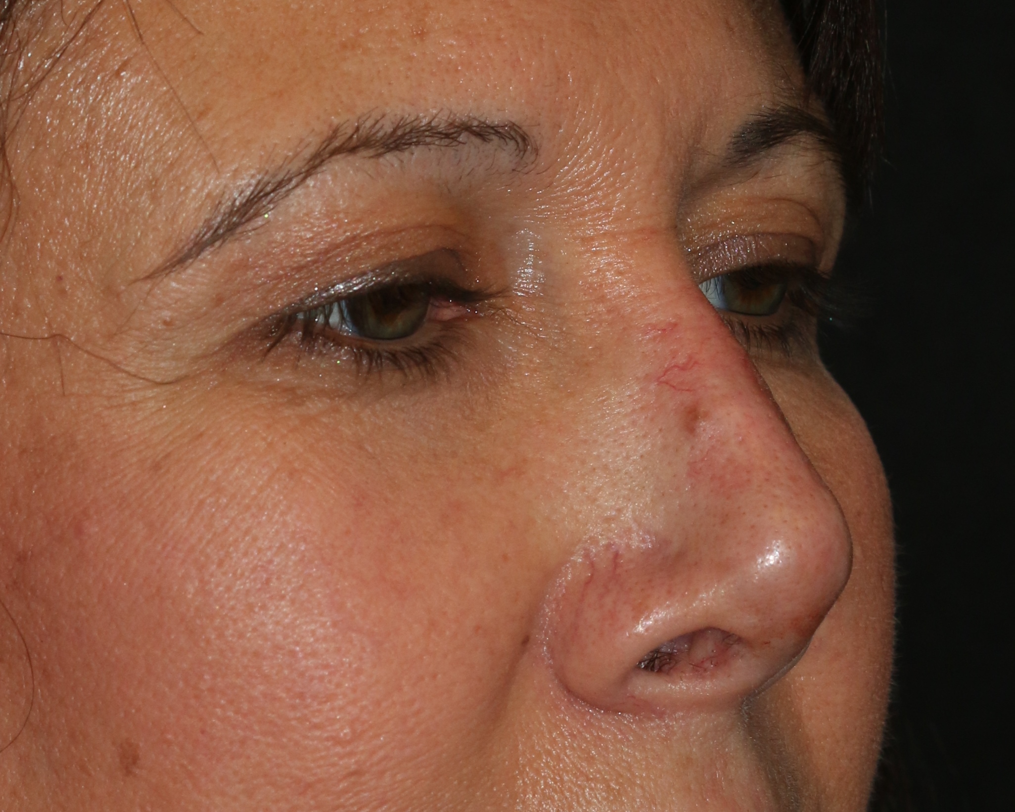 Non-Surgical Rhinoplasty utilizing Restylane Filler