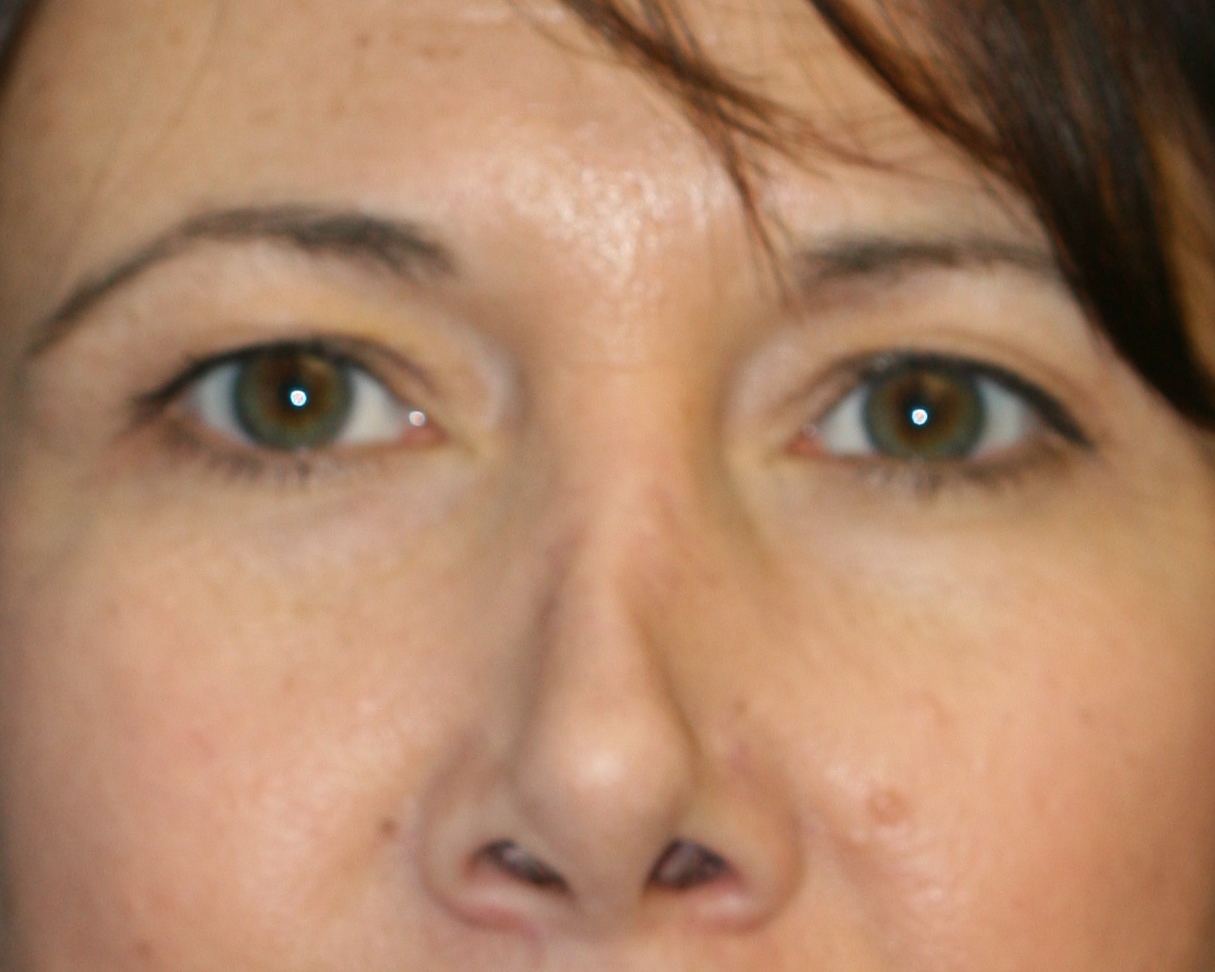 Non-Surgical Rhinoplasty - Before & After - Dr. Placik