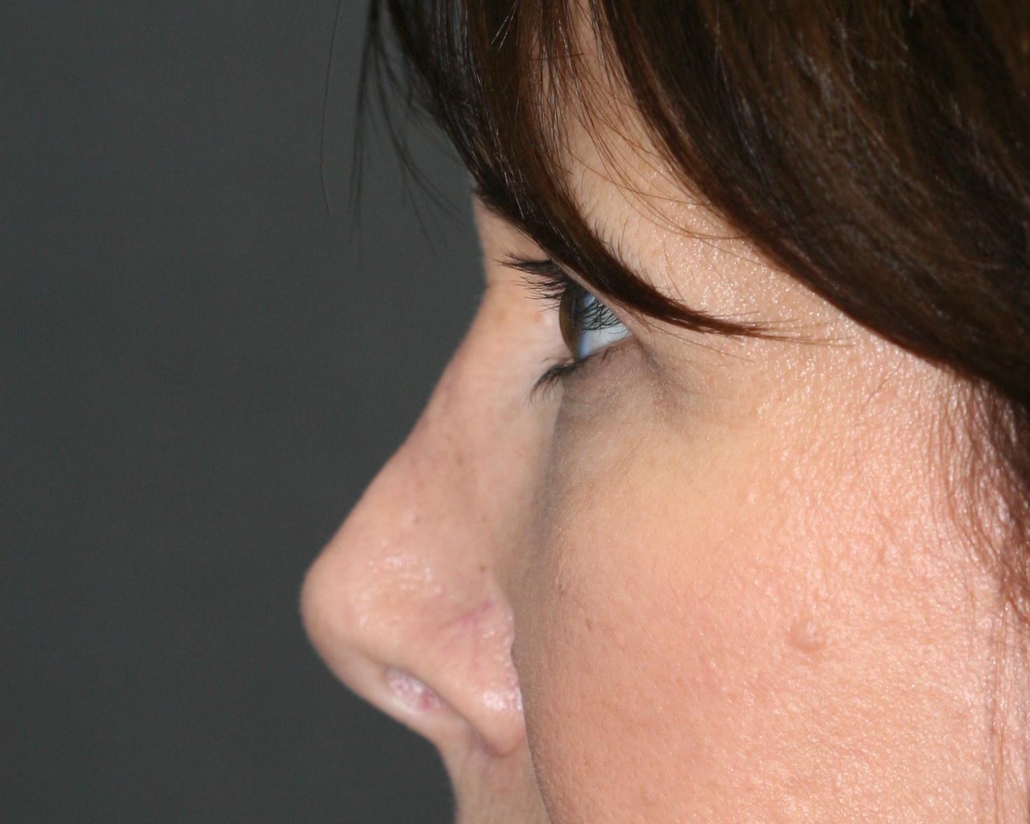 Non-Surgical Rhinoplasty utilizing Restylane Filler